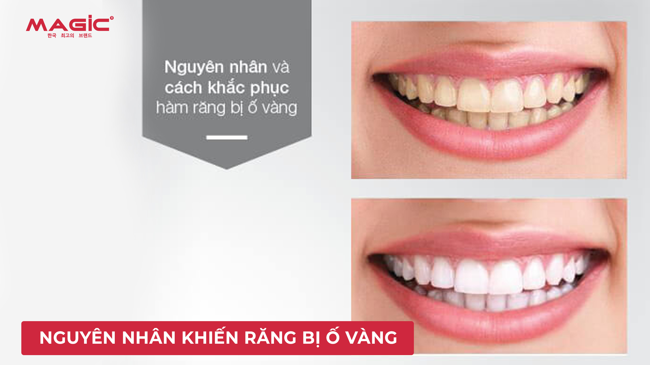 Kem Đánh Răng Có Giúp Trắng Răng Không? Cách Chọn Kem Đánh Răng Trắng Răng 2 kem đánh răng