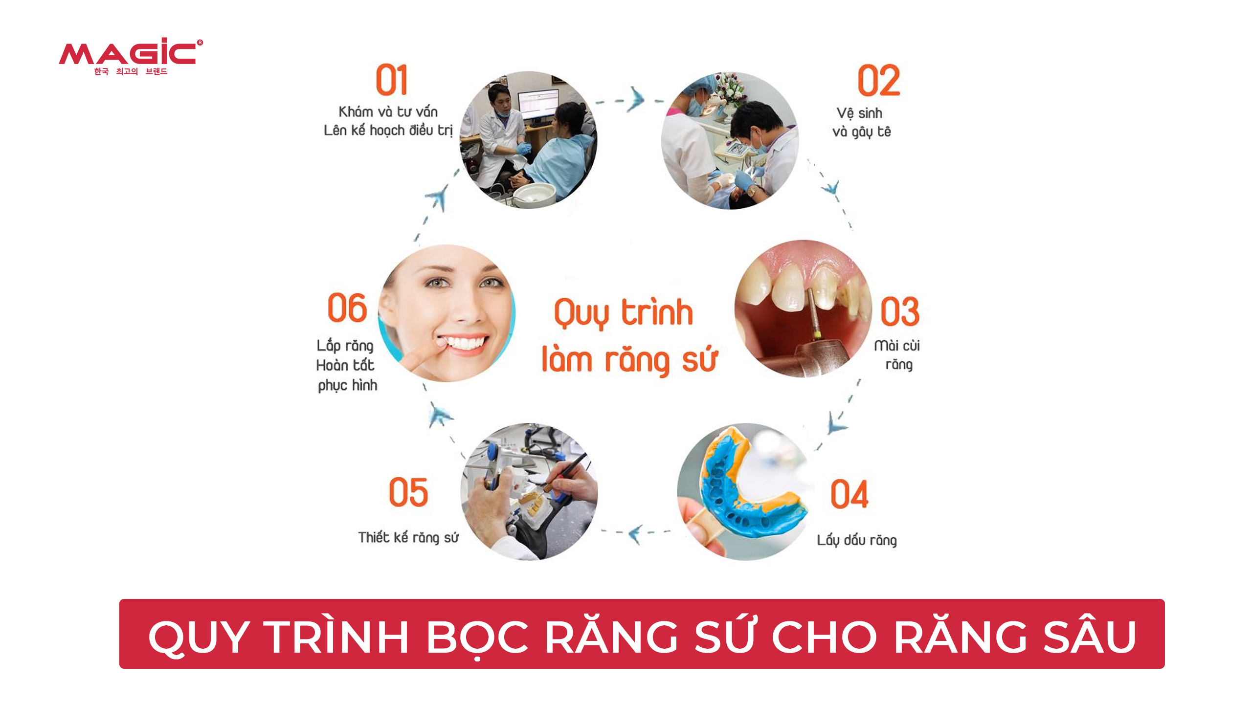 Bọc Răng Sứ Cho Răng Sâu Hay Trám Răng Sâu Tốt Hơn 5 Minh họa quy trình bọc răng sứ