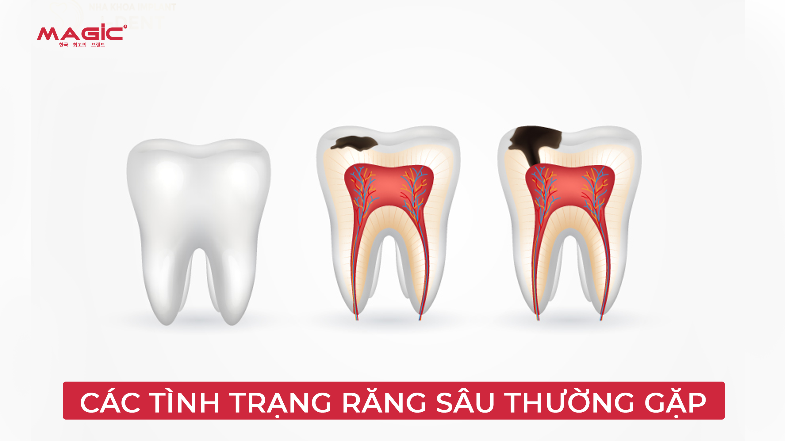 Bọc Răng Sứ Cho Răng Sâu Hay Trám Răng Sâu Tốt Hơn 1 Minh họa các trường hợp răng sâu