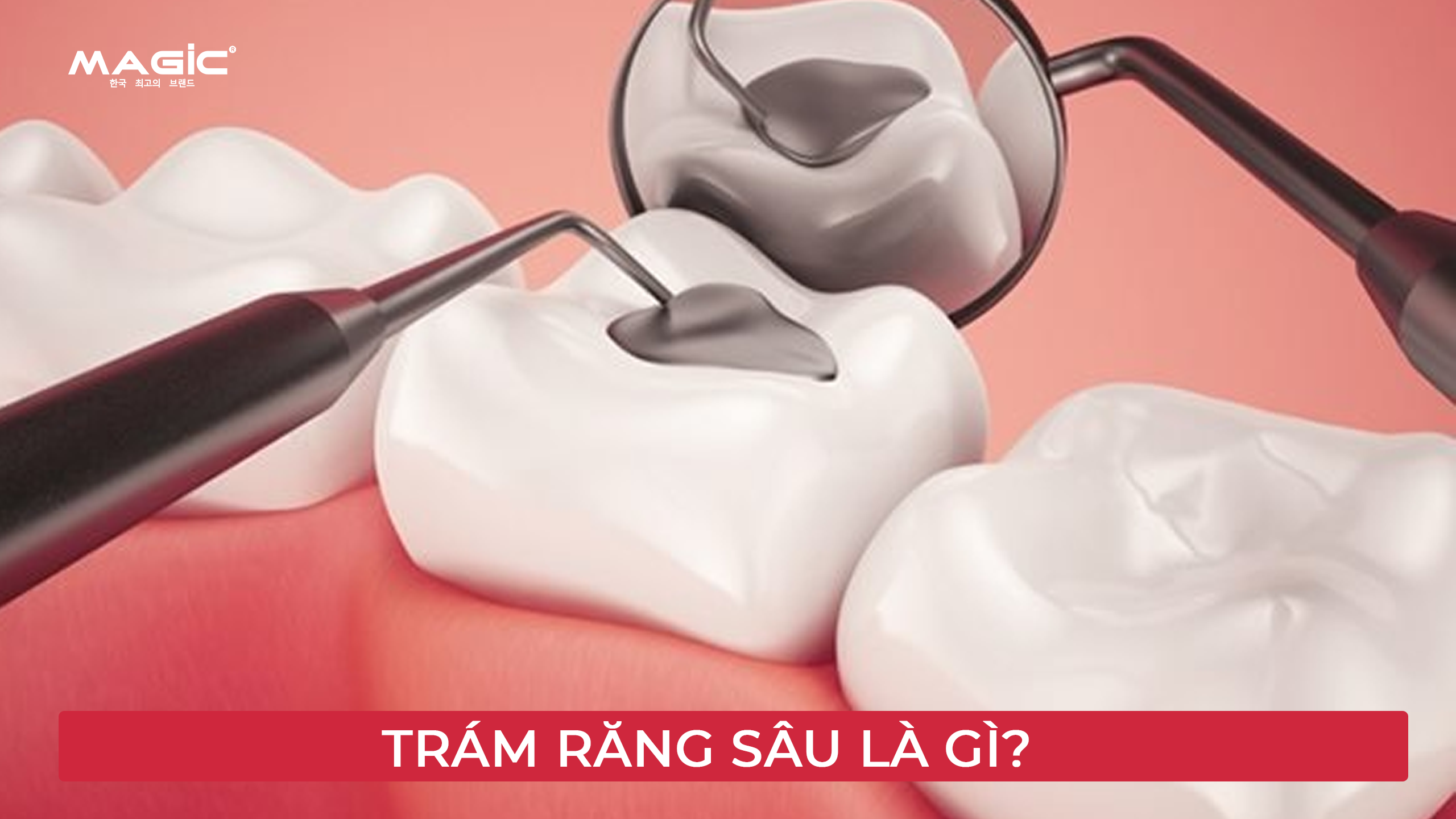 Bọc Răng Sứ Cho Răng Sâu Hay Trám Răng Sâu Tốt Hơn 2 Minh họa trám răng sâu là gì