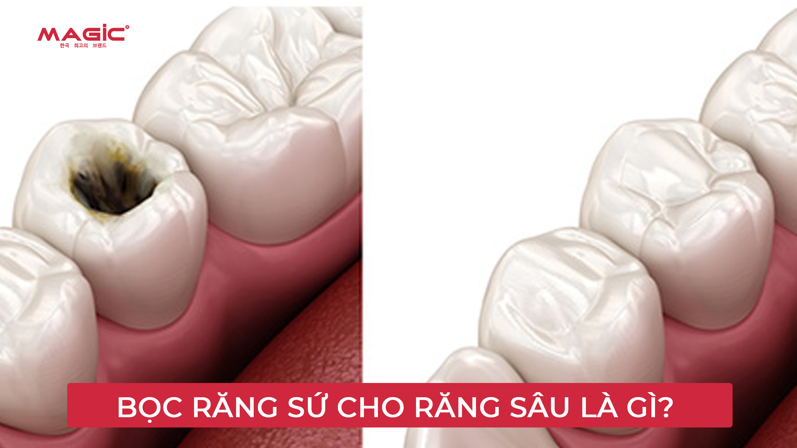 Bọc Răng Sứ Cho Răng Sâu Hay Trám Răng Sâu Tốt Hơn 3 Minh họa bọc răng sứ cho răng sâu