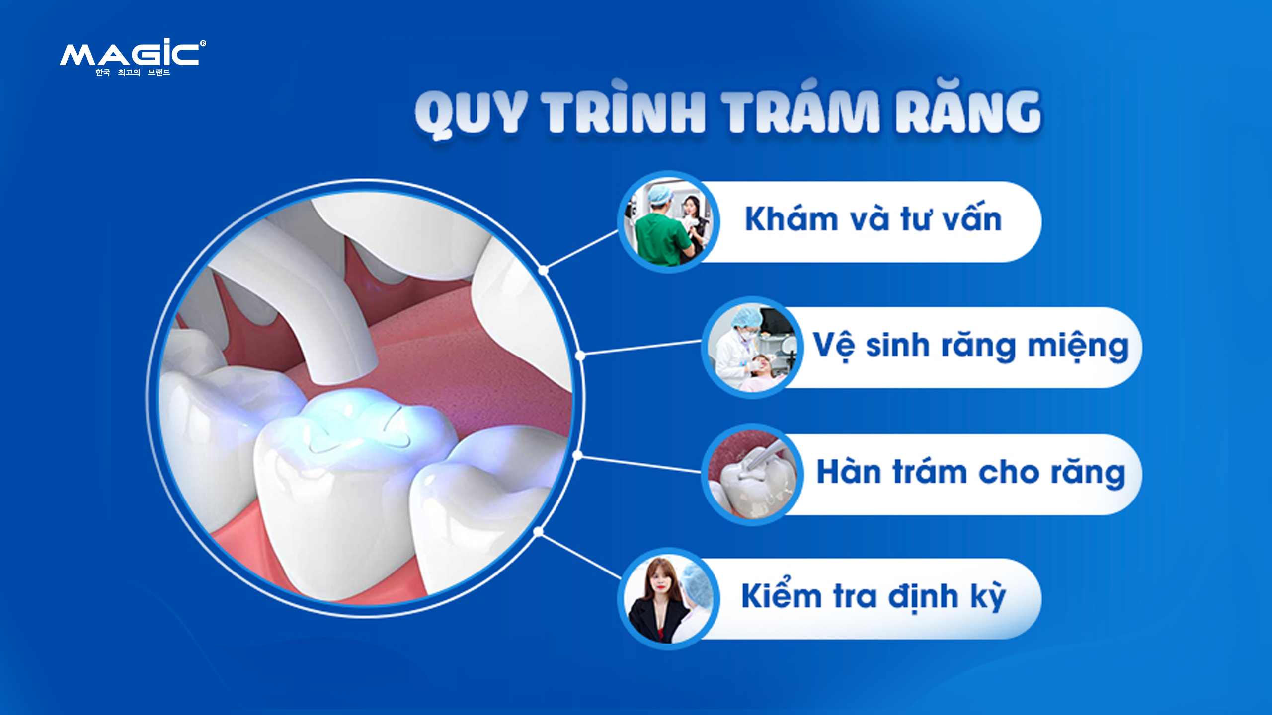 Bọc Răng Sứ Cho Răng Sâu Hay Trám Răng Sâu Tốt Hơn 4 Minh họa quy trình trám răng