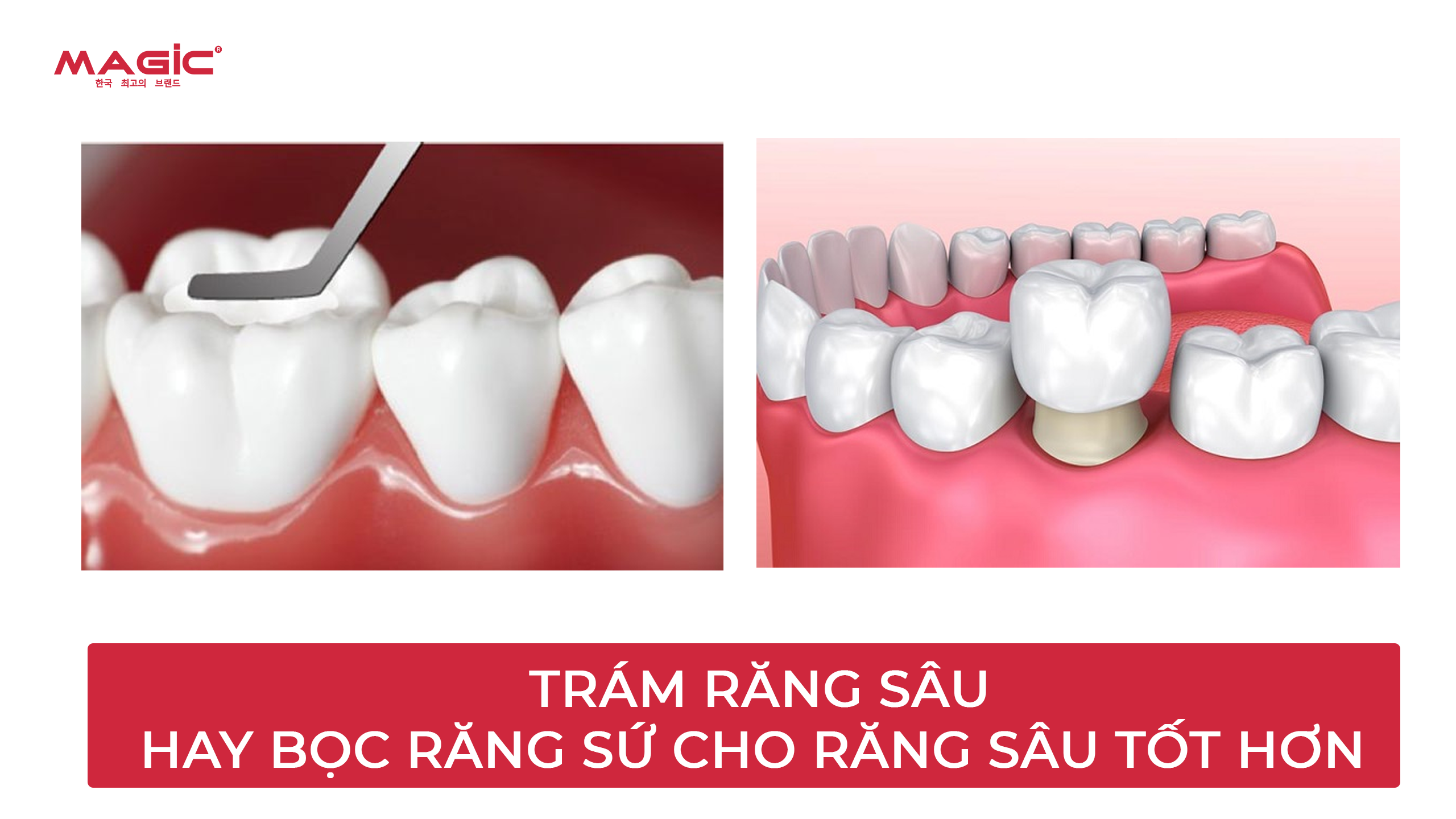 Bọc Răng Sứ Cho Răng Sâu Hay Trám Răng Sâu Tốt Hơn 6 Minh họa bọc răng sứ hay trám răng cho răng sâu