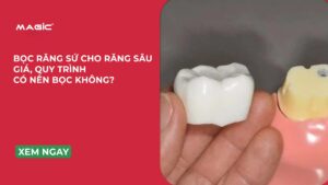 Bọc Răng Sứ Cho Răng Sâu: Giá, Quy Trình, Có Nên Bọc Không? 4