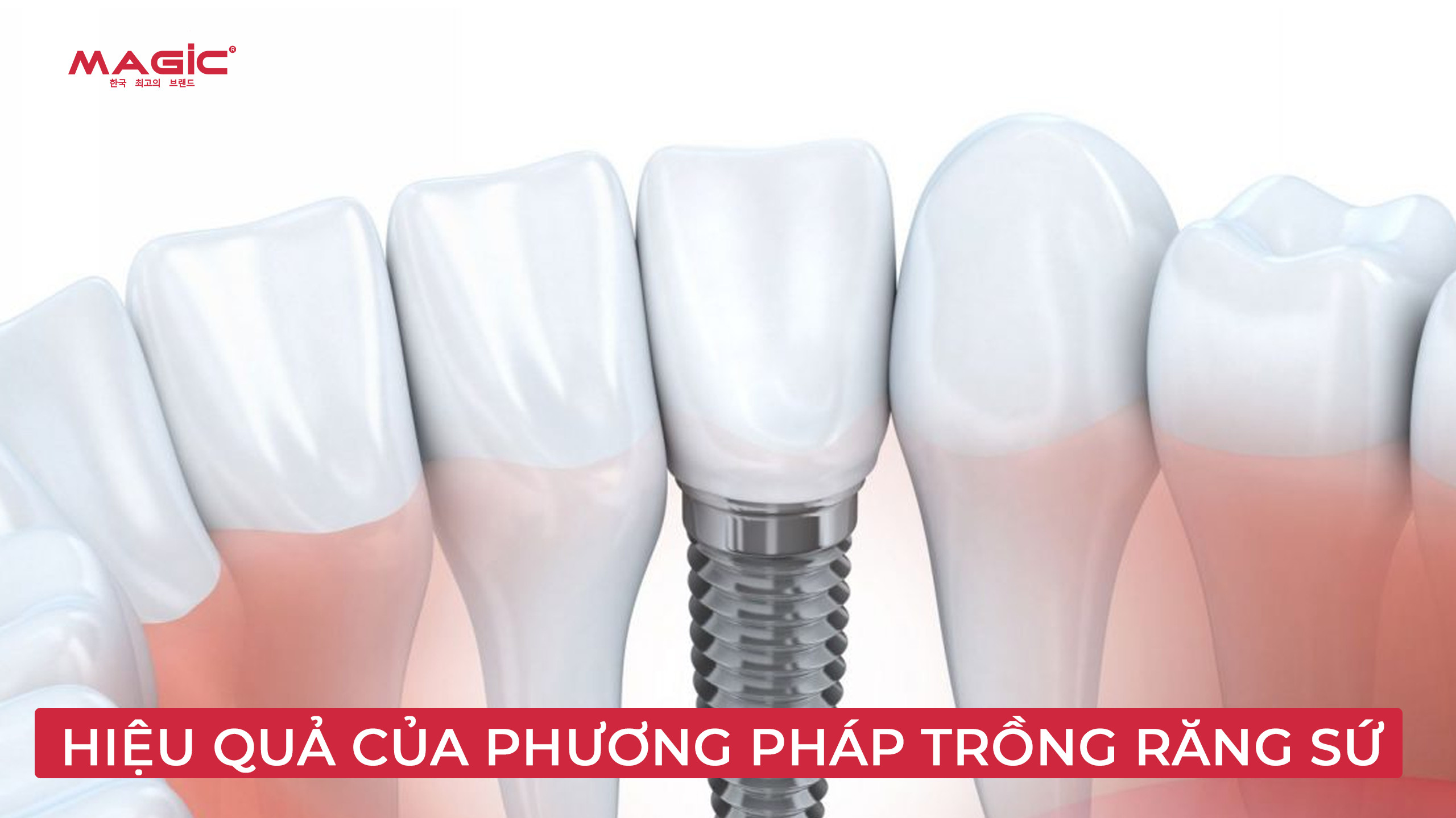 hiệu quả thẩm mỹ của phương pháp trồng răng sứ 