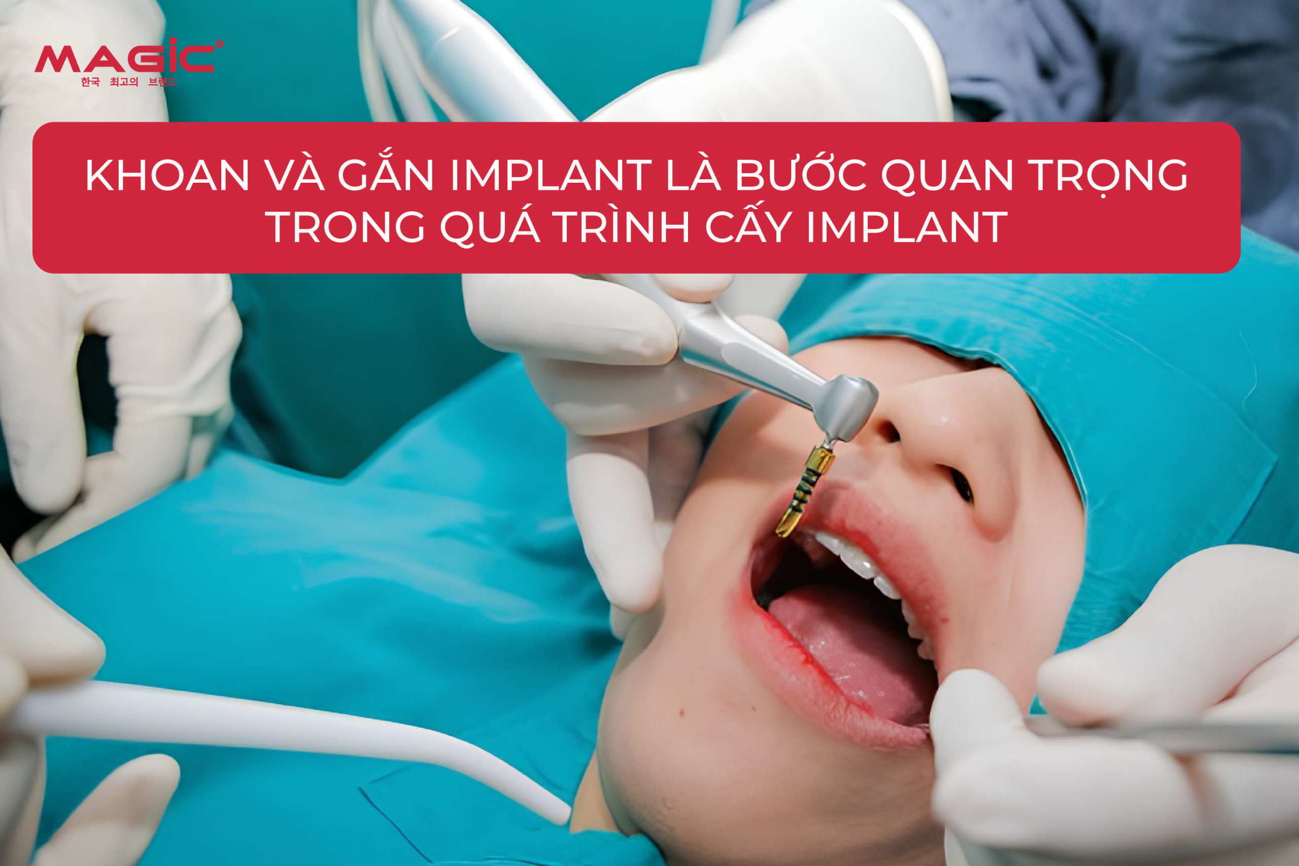 Cấy Implant Có Đau Không? Quá Trình Diễn Ra Như Thế Nào 1 Cấy Implant Có Đau Không? Quá Trình Diễn Ra Như Thế Nào 1