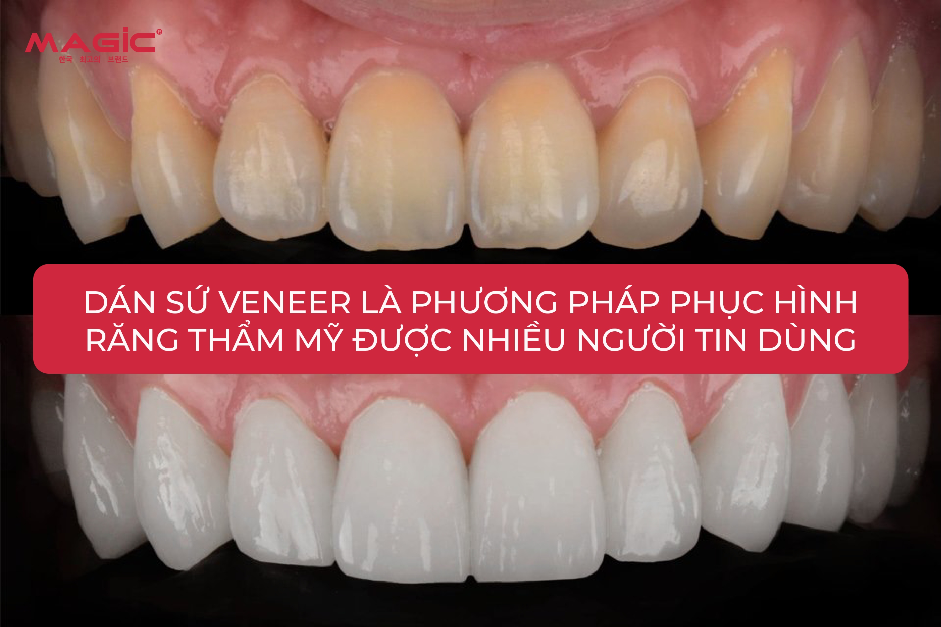 Răng Sứ Veneer Là Gì? Cấp Độ Mài Răng, Ưu Nhược Điểm 1