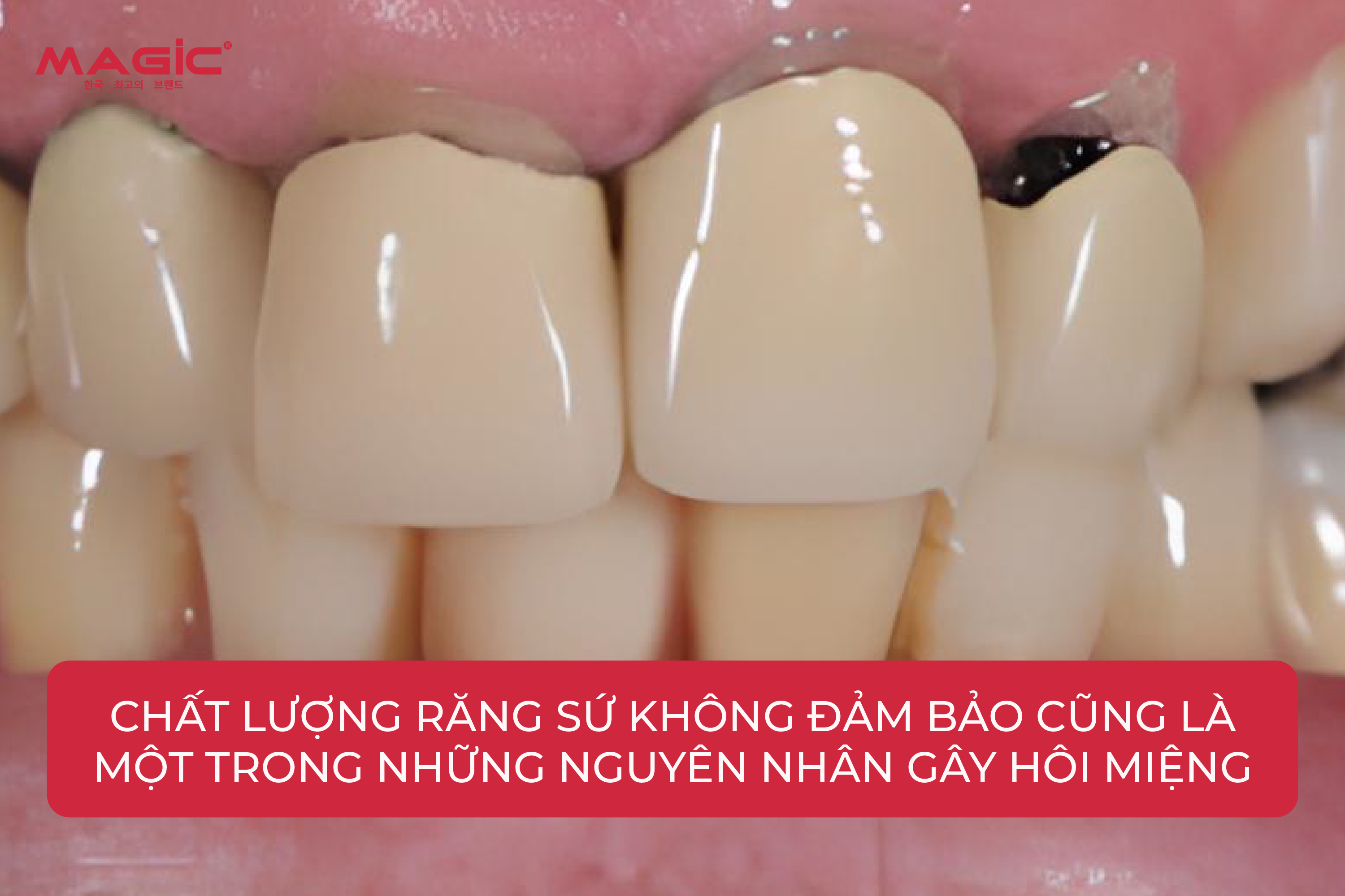 Nguyên Nhân Bọc Răng Sứ Bị Hôi Miệng, Cách Khắc Phục 1 Nguyên Nhân Bọc Răng Sứ Bị Hôi Miệng, Cách Khắc Phục 1