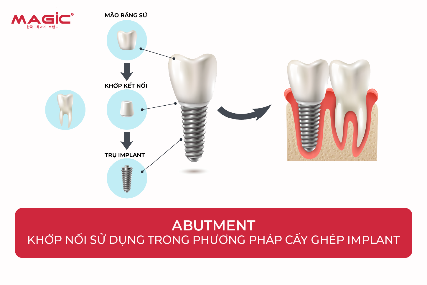 9 Thông Tin Về Abutment Cá Nhân Cần Biết Trước Khi Làm 1