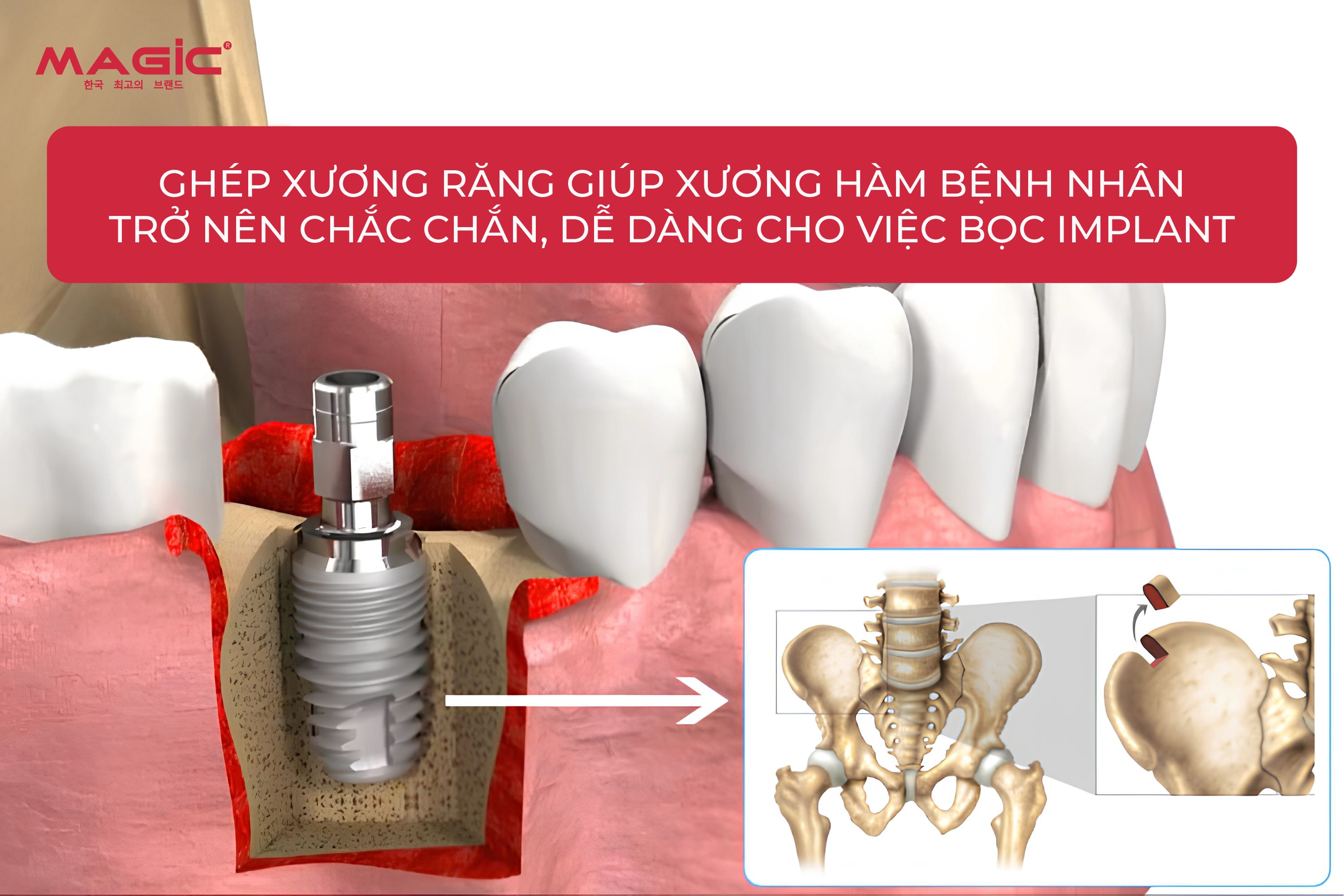 Ghép Xương Răng Là Gì? Khi Nào Cần Ghép Xương Răng 1 Ghép Xương Răng Là Gì? Khi Nào Cần Ghép Xương Răng 1