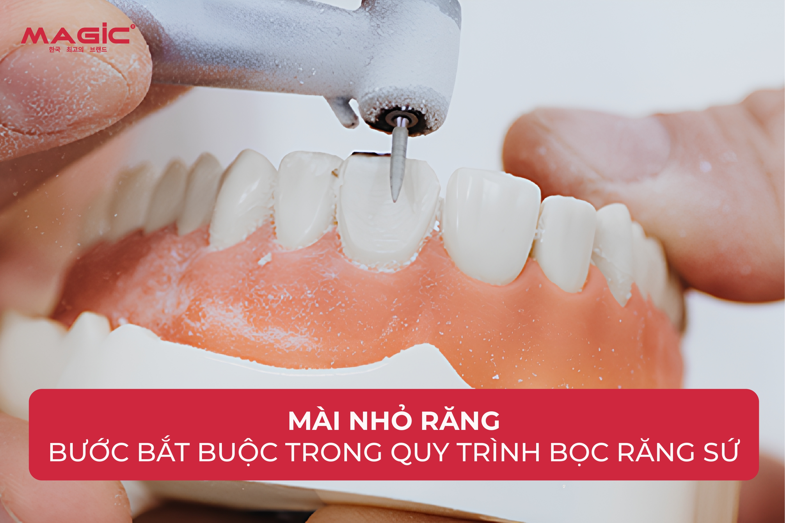 9 Bước Trong Quy Trình Làm Răng Sứ 1 9 Bước Trong Quy Trình Làm Răng Sứ 1