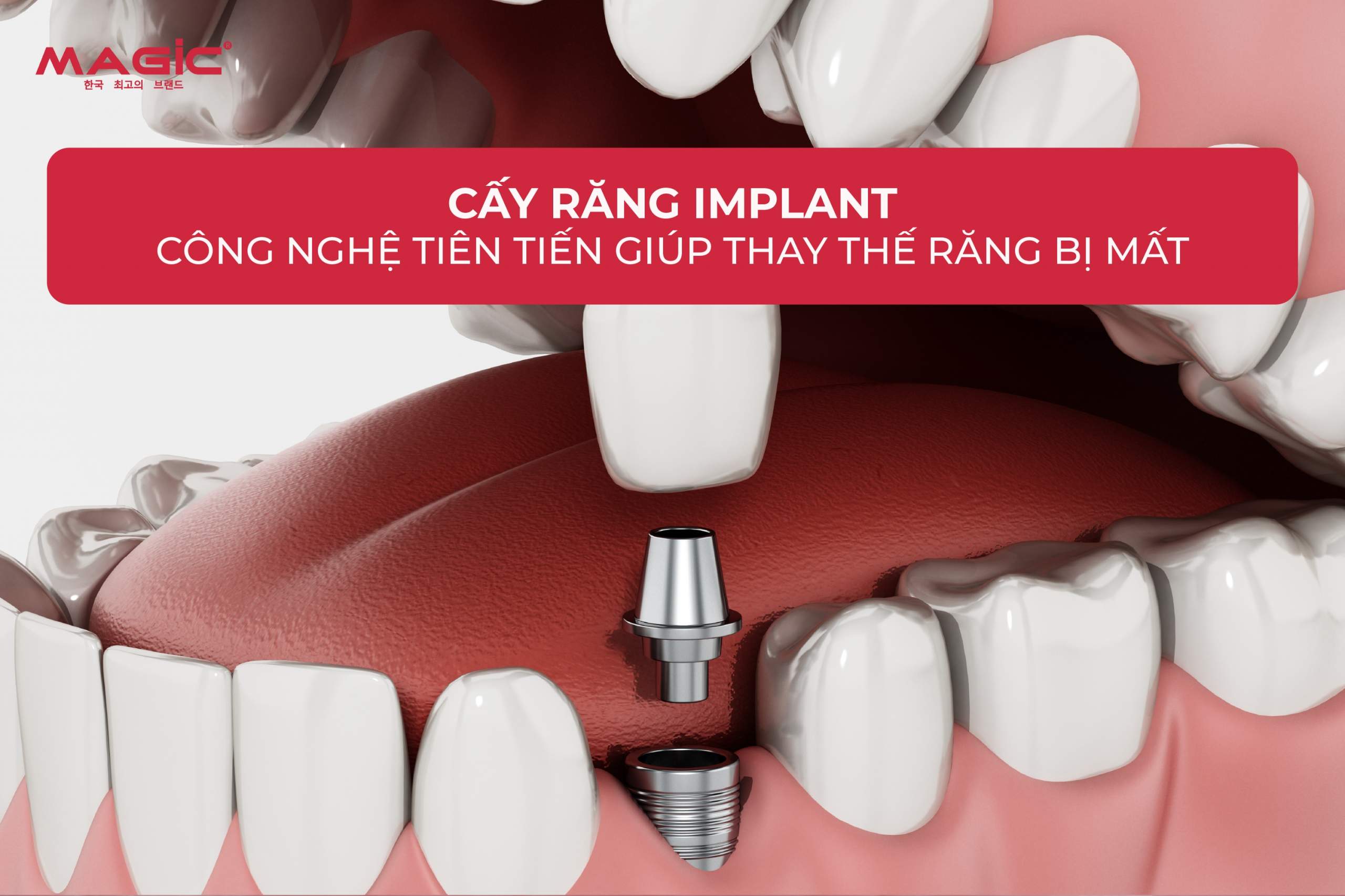 Quy Trình 9 Bước Cấy Răng Implant Chuẩn Nha Khoa 1