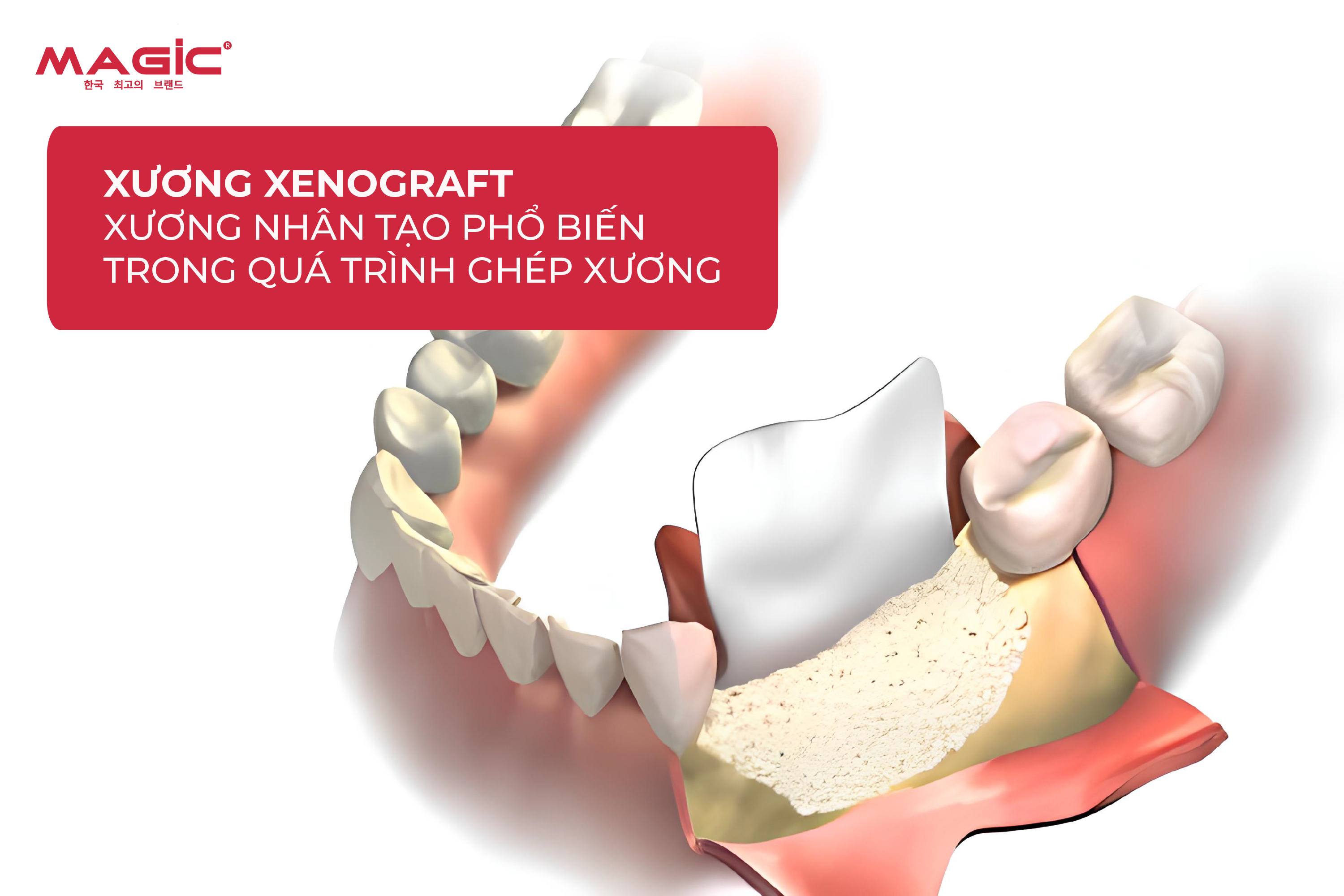 Ghép Xương Răng Là Gì? Khi Nào Cần Ghép Xương Răng 2 Ghép Xương Răng Là Gì? Khi Nào Cần Ghép Xương Răng 2