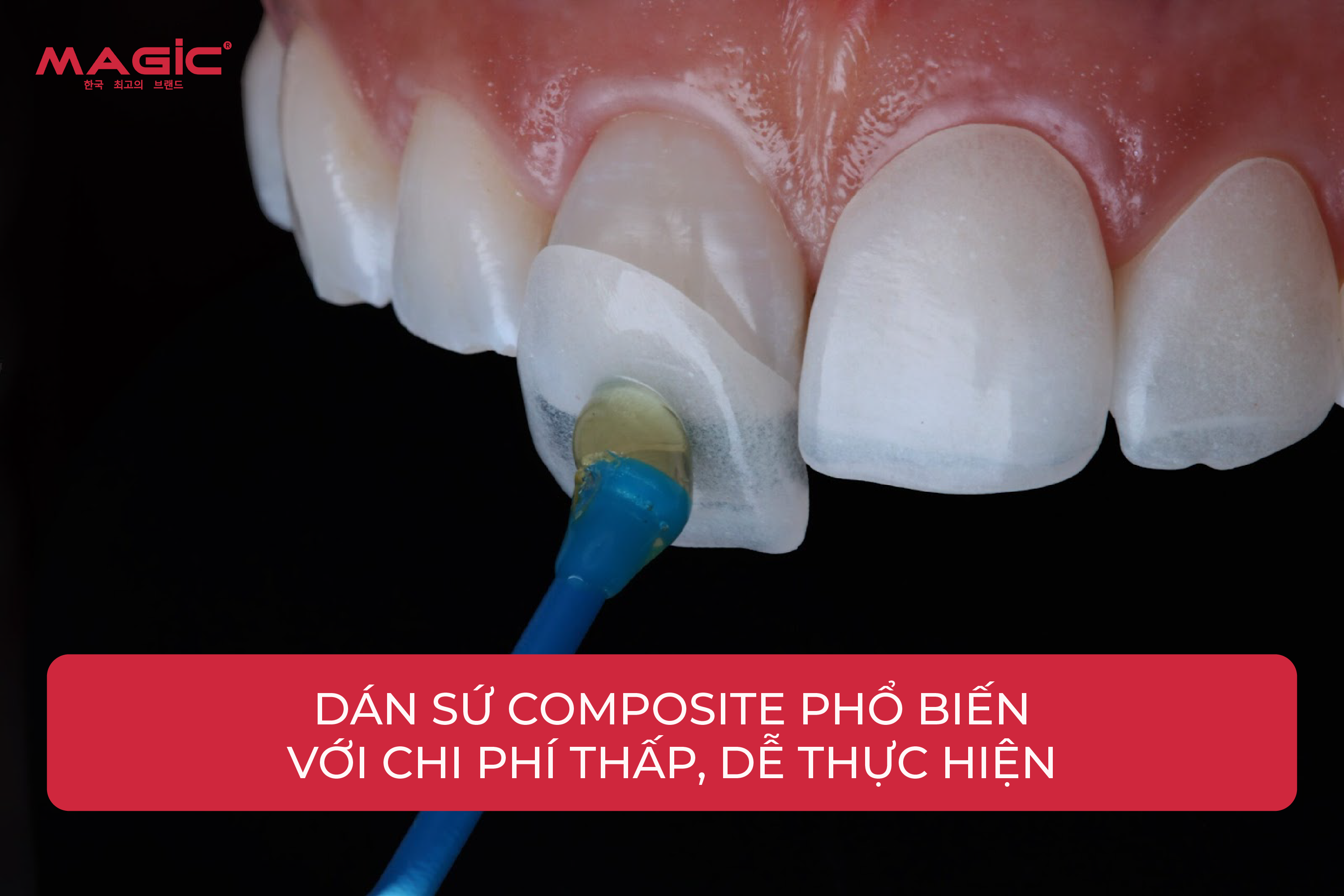 Răng Sứ Veneer Là Gì? Cấp Độ Mài Răng, Ưu Nhược Điểm 2