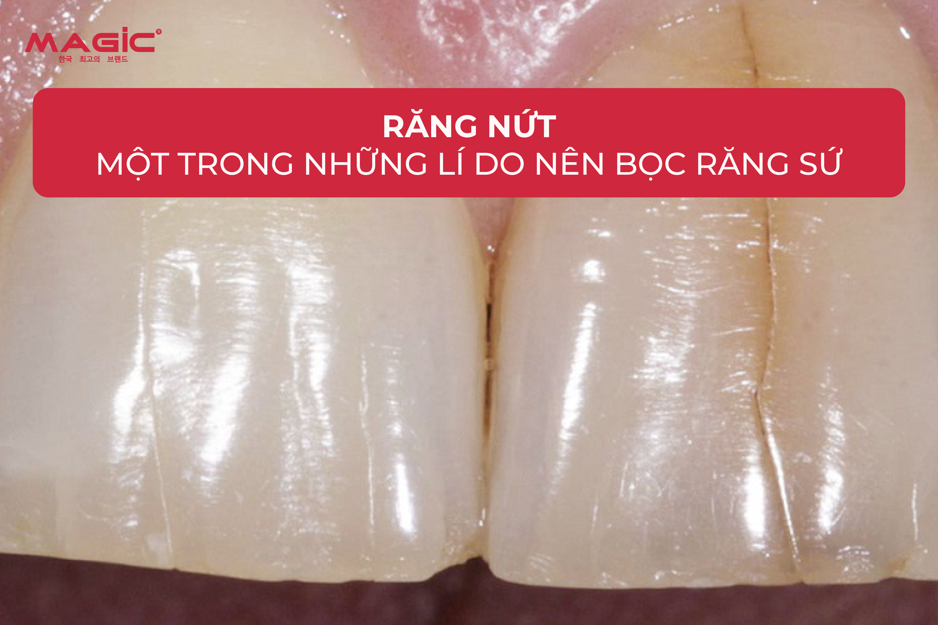 9 Bước Trong Quy Trình Làm Răng Sứ 2 9 Bước Trong Quy Trình Làm Răng Sứ 2
