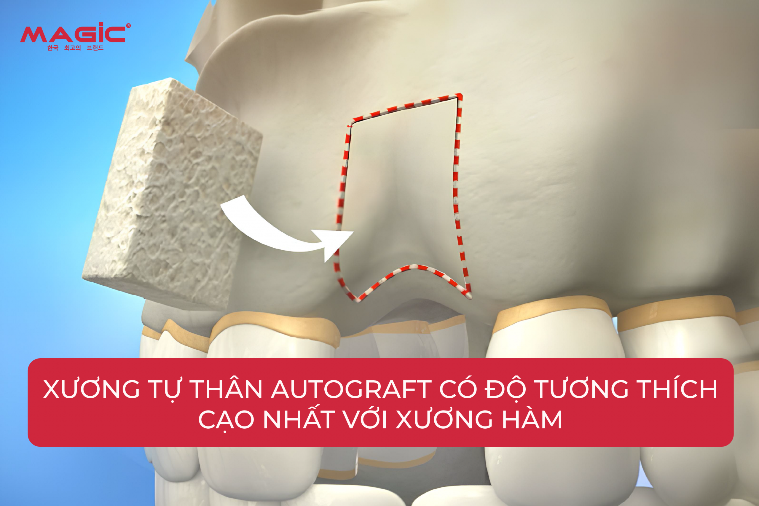 Ghép Xương Răng Là Gì? Khi Nào Cần Ghép Xương Răng 3 Ghép Xương Răng Là Gì? Khi Nào Cần Ghép Xương Răng 3