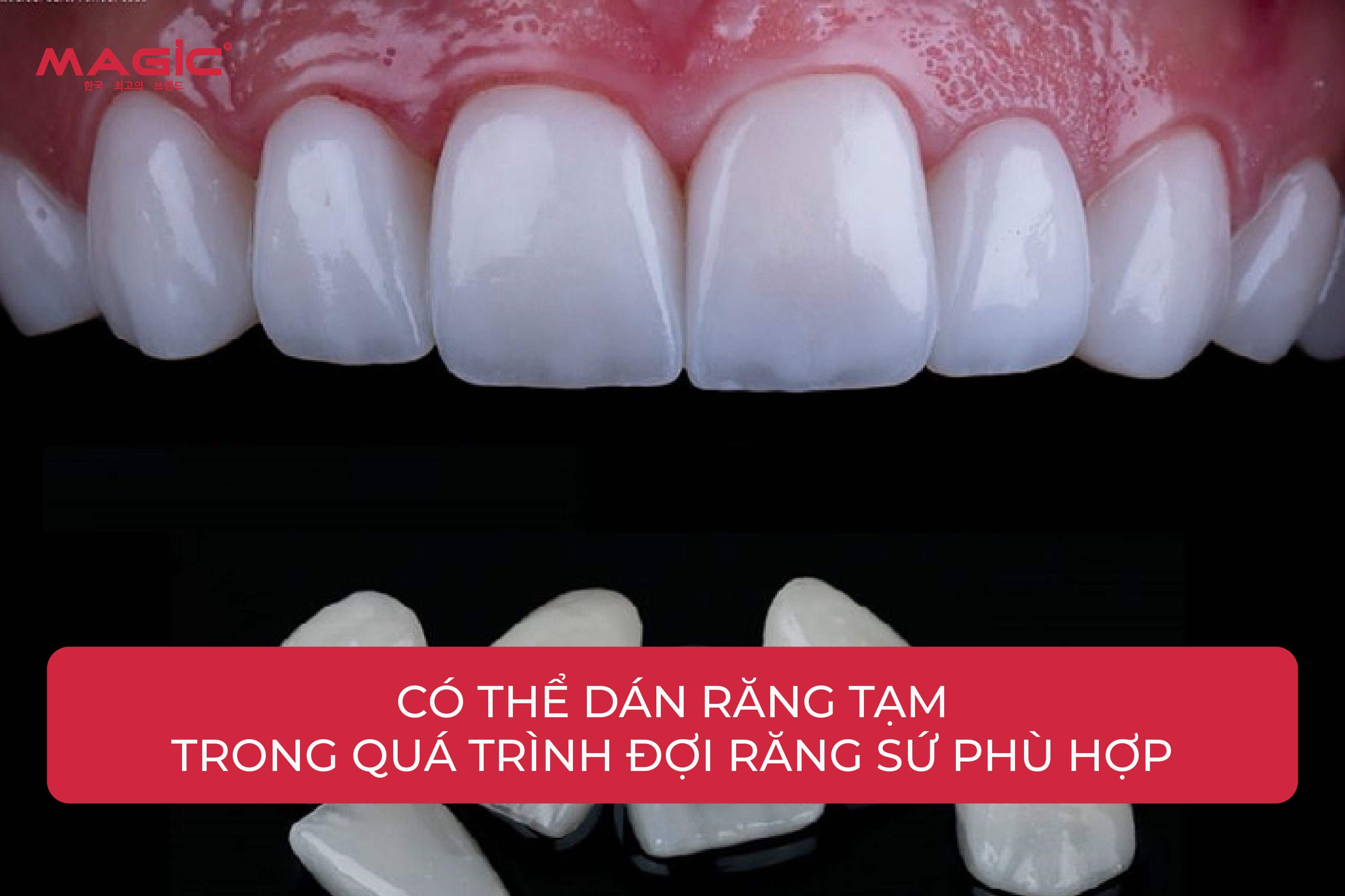 9 Bước Trong Quy Trình Làm Răng Sứ 4 9 Bước Trong Quy Trình Làm Răng Sứ 4