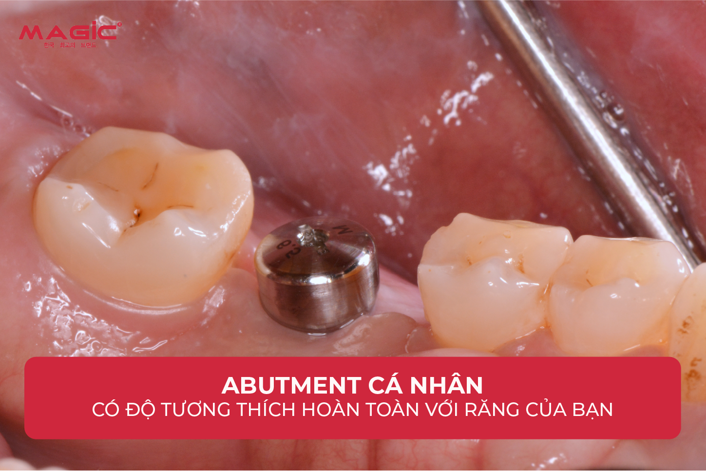 9 Thông Tin Về Abutment Cá Nhân Cần Biết Trước Khi Làm 4