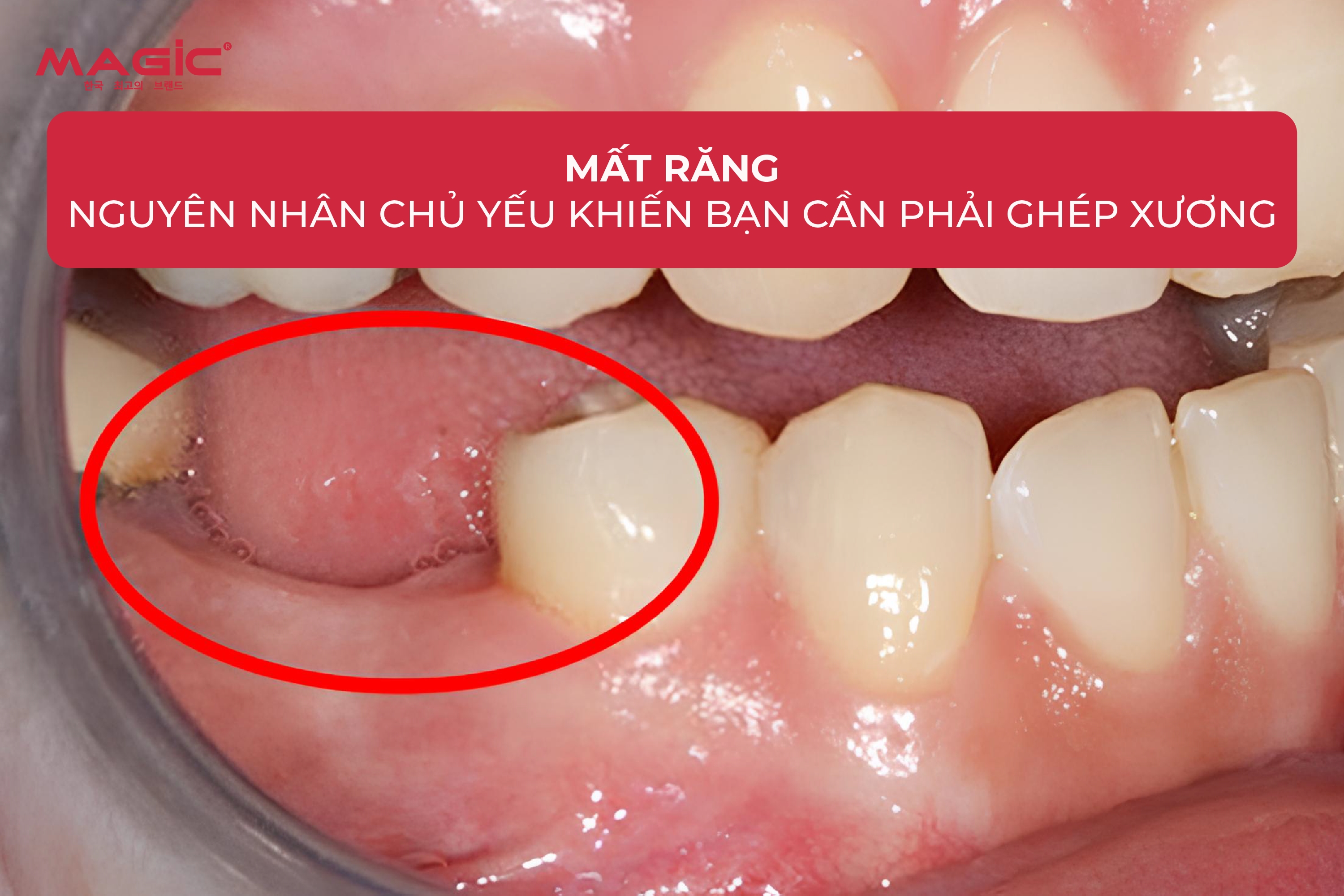 Ghép Xương Răng Là Gì? Khi Nào Cần Ghép Xương Răng 4 Ghép Xương Răng Là Gì? Khi Nào Cần Ghép Xương Răng 4