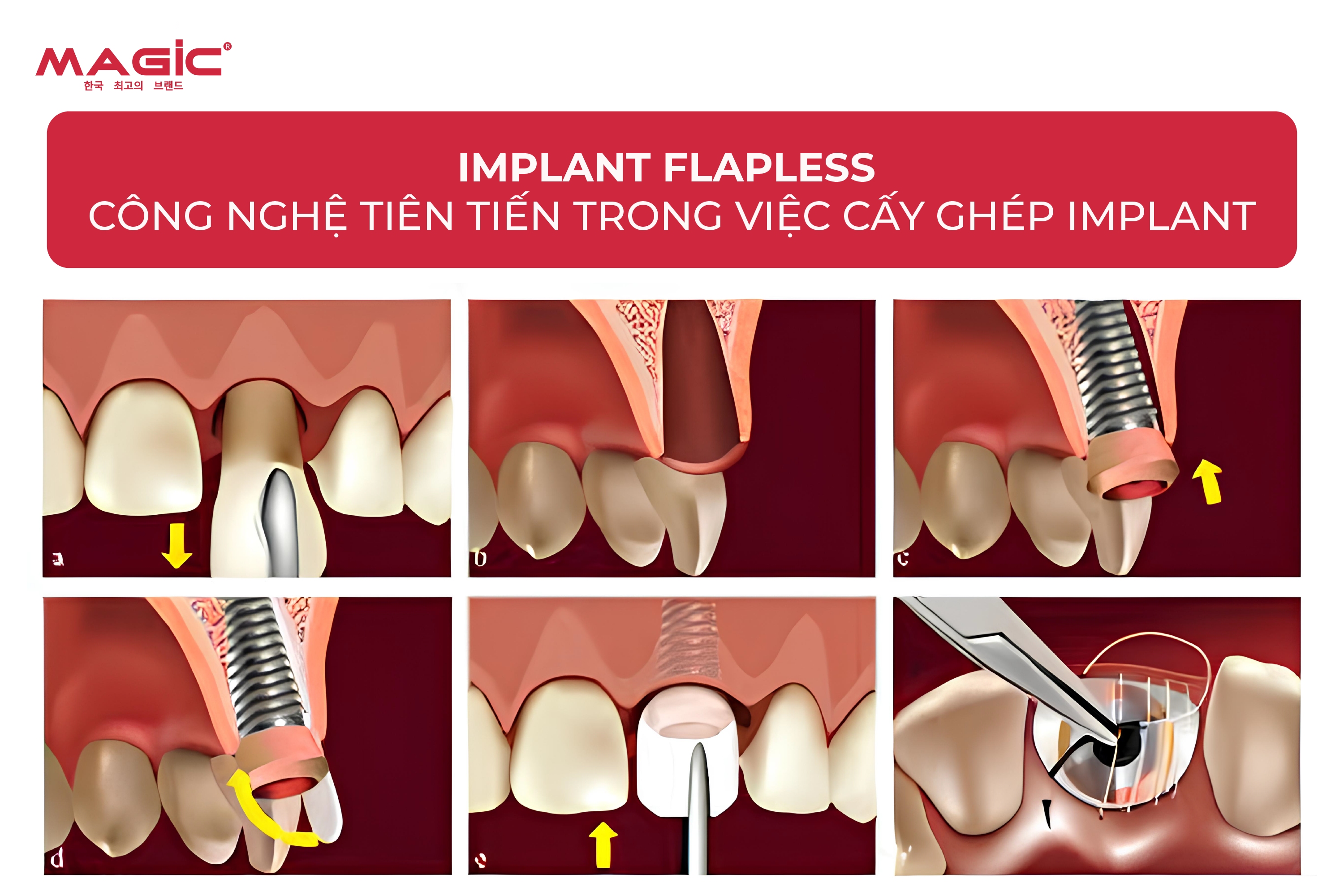 Cấy Implant Có Đau Không? Quá Trình Diễn Ra Như Thế Nào 5 Cấy Implant Có Đau Không? Quá Trình Diễn Ra Như Thế Nào 5