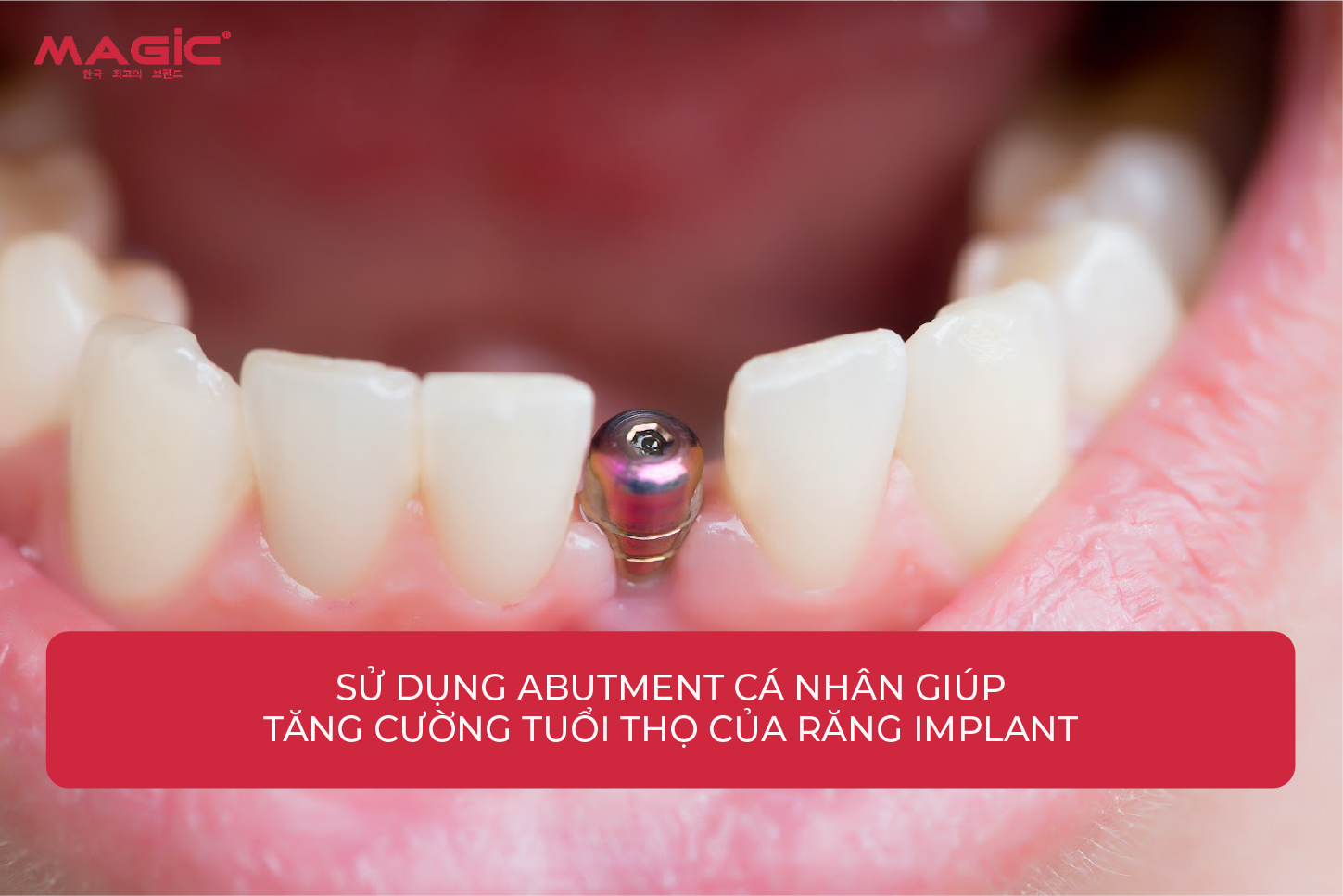 9 Thông Tin Về Abutment Cá Nhân Cần Biết Trước Khi Làm 5