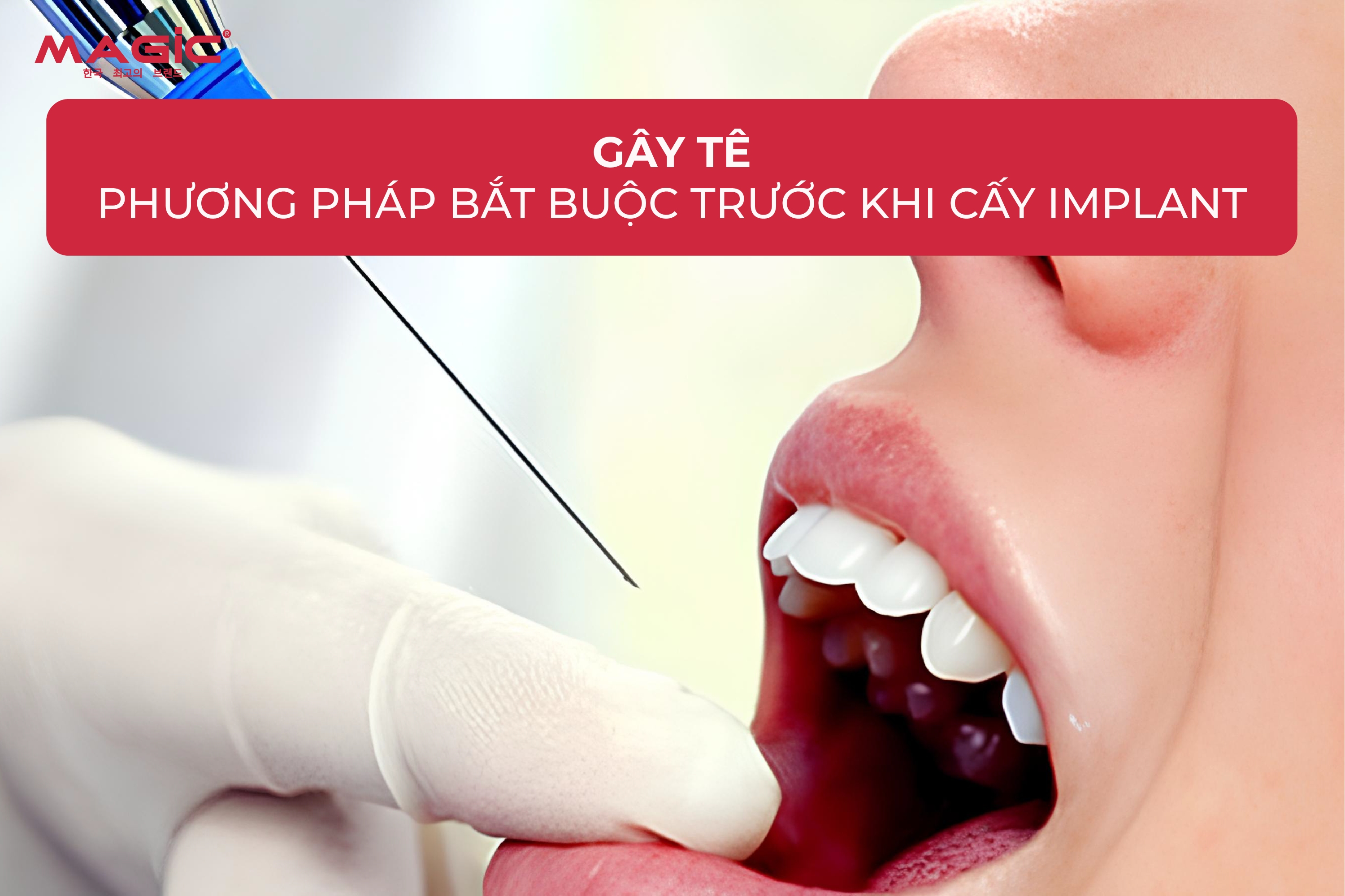Cấy Implant Có Đau Không? Quá Trình Diễn Ra Như Thế Nào 4 Cấy Implant Có Đau Không? Quá Trình Diễn Ra Như Thế Nào 4