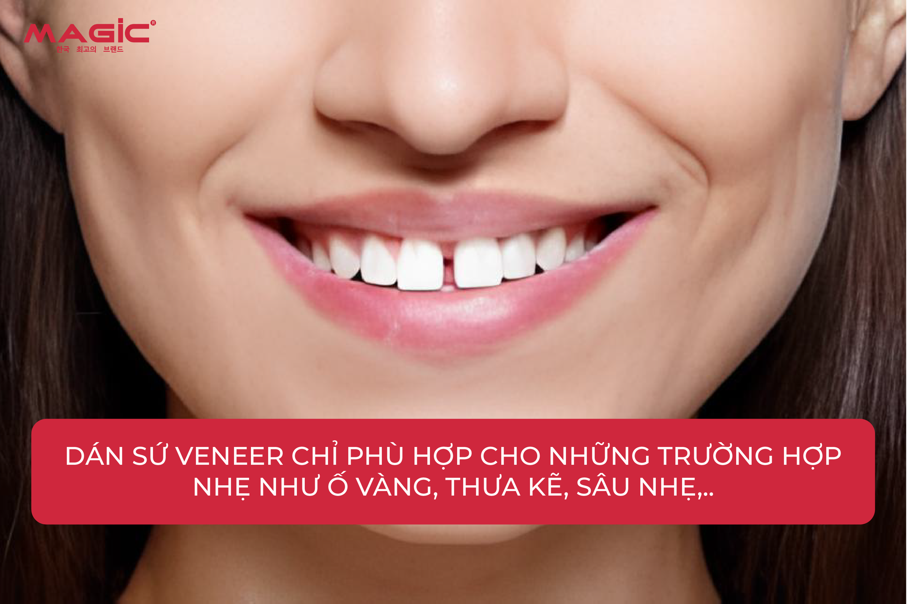 Răng Sứ Veneer Là Gì? Cấp Độ Mài Răng, Ưu Nhược Điểm 5