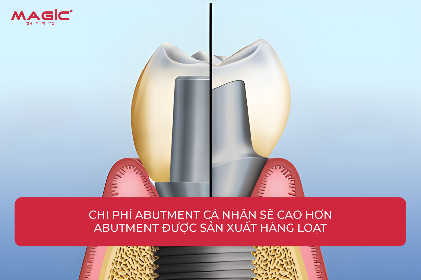 9 Thông Tin Về Abutment Cá Nhân Cần Biết Trước Khi Làm 6