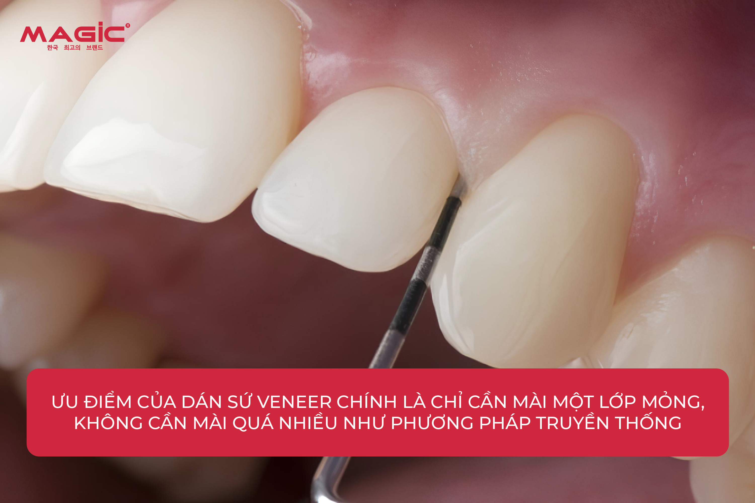 Răng Sứ Veneer Là Gì? Cấp Độ Mài Răng, Ưu Nhược Điểm 6
