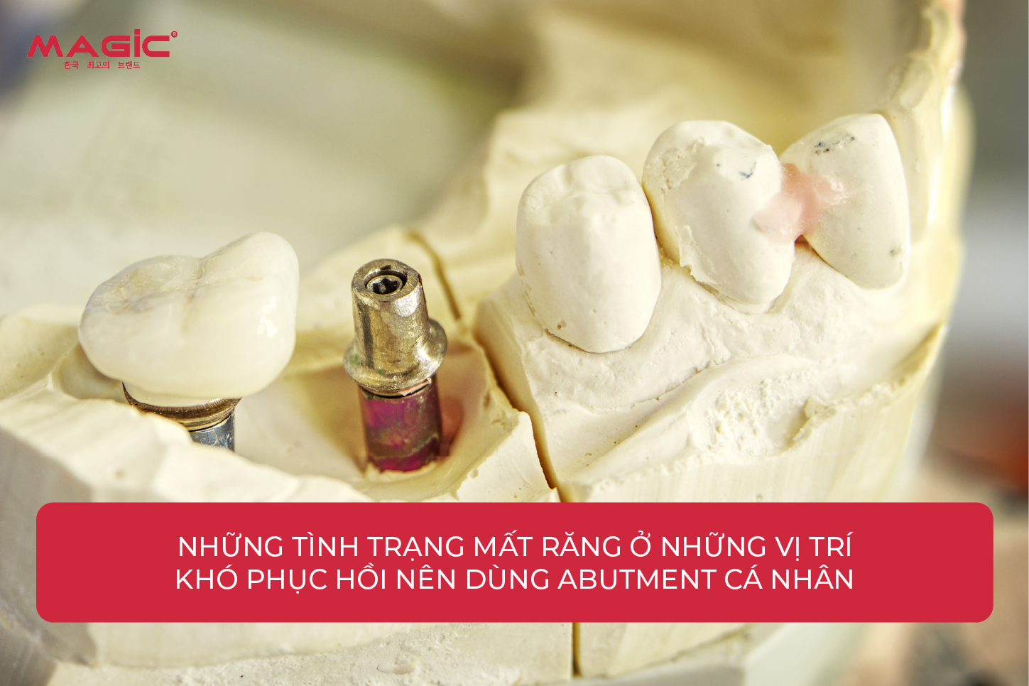9 Thông Tin Về Abutment Cá Nhân Cần Biết Trước Khi Làm 7