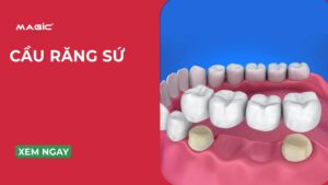 5 Phương Pháp Cầu Răng Sứ & Tình Trạng Răng Nên Bắc Cầu Răng Sứ 1