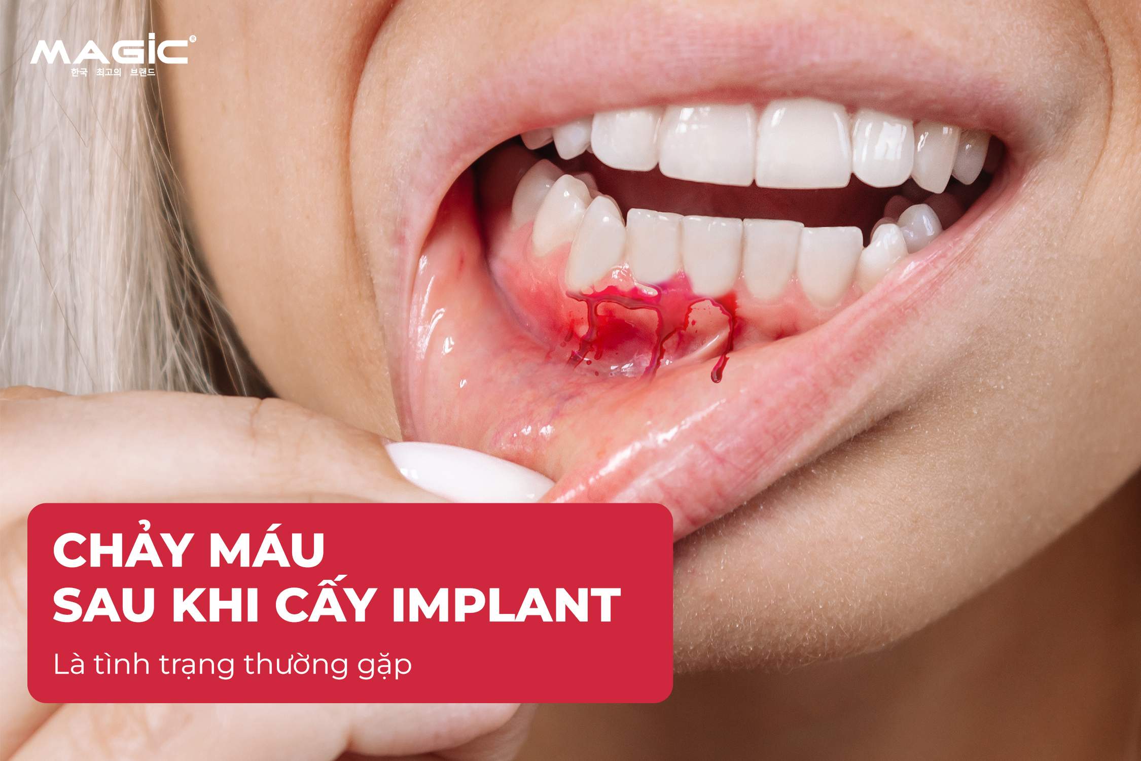 9 Dấu Hiệu Trụ Implant Bị Đào Thải Sau Khi Cấy Implant 1