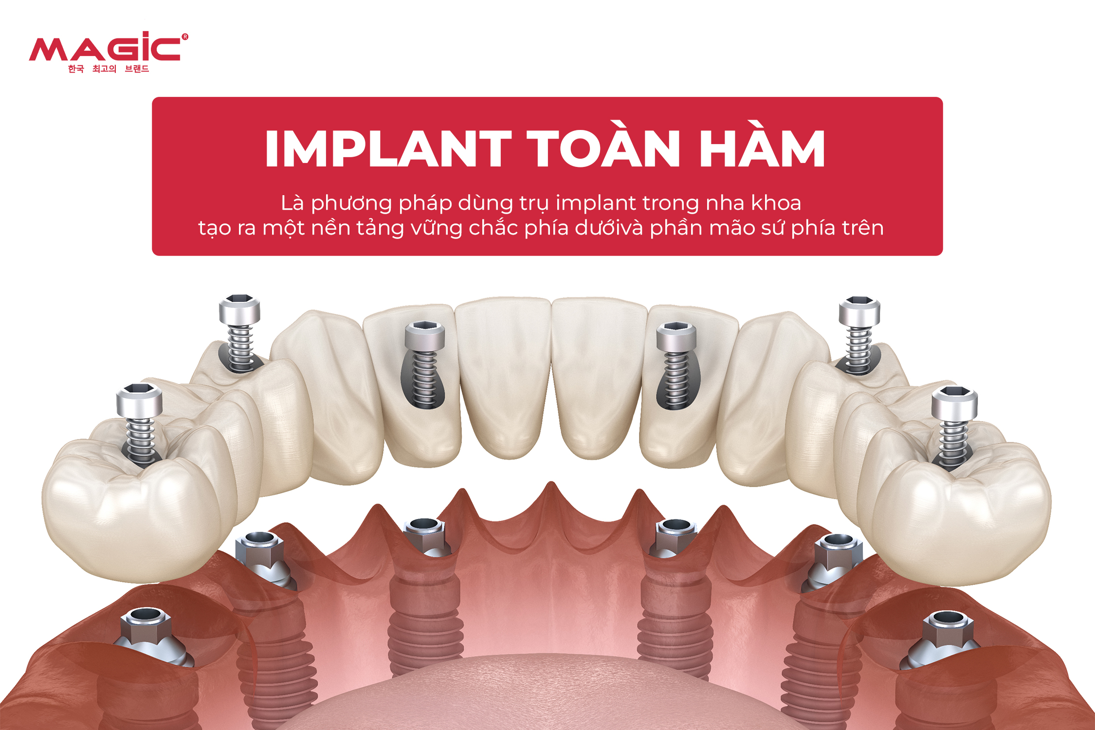 So Sánh Cấy Ghép Implant Toàn Hàm All-on-4, All-on-6, All-on-8 1 So Sánh Cấy Ghép Implant Toàn Hàm All-on-4, All-on-6, All-on-8 1