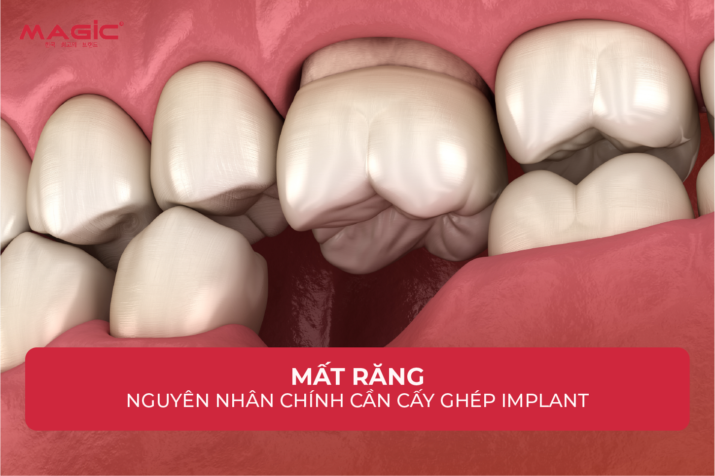 Từ A-Z Cấy Ghép Implant Là Gì? Nên Nắm Rõ Trước Khi Làm 2