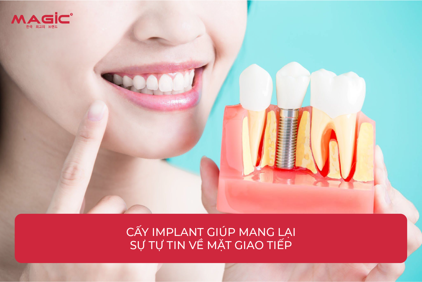 Từ A-Z Cấy Ghép Implant Là Gì? Nên Nắm Rõ Trước Khi Làm 1