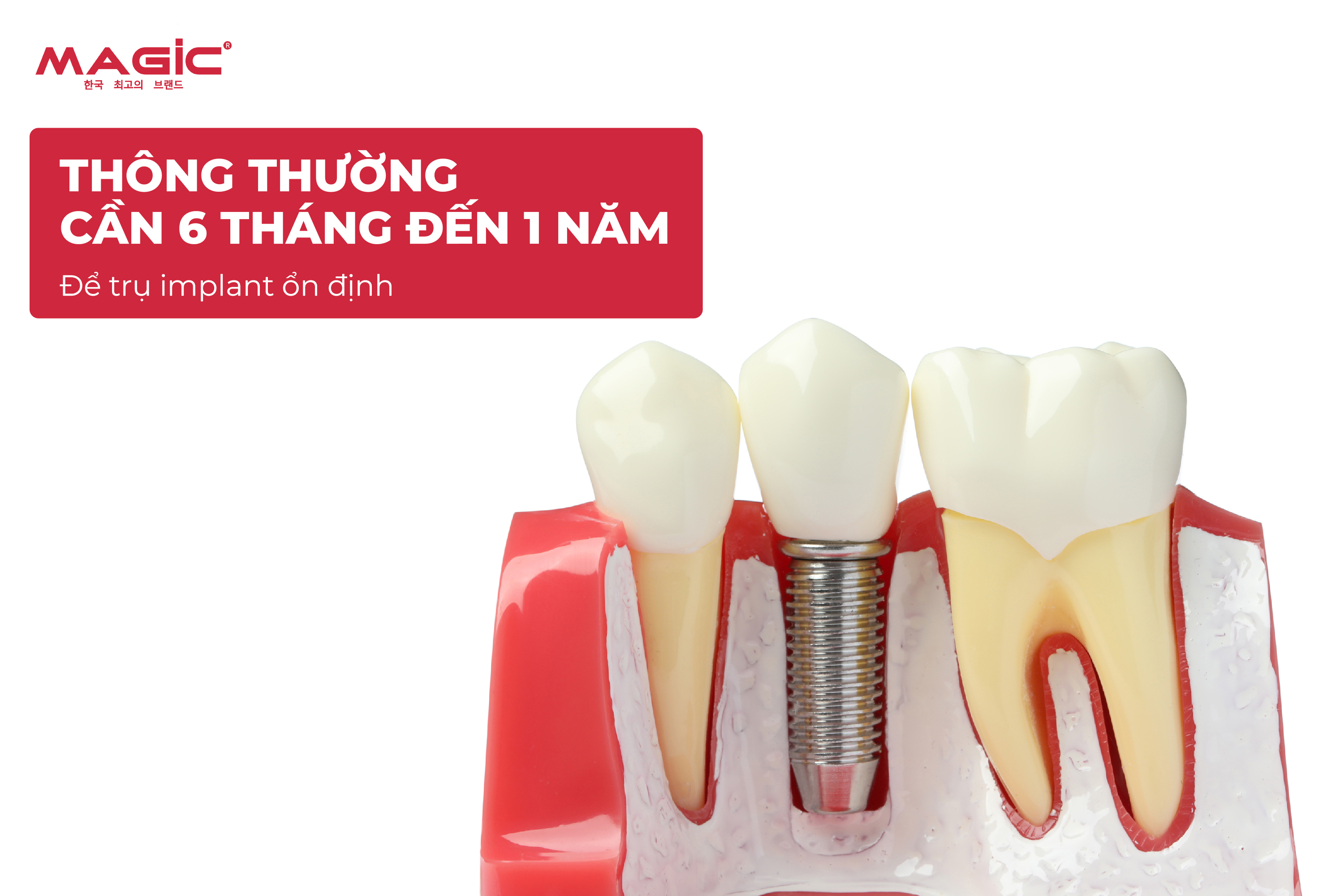 9 Dấu Hiệu Trụ Implant Bị Đào Thải Sau Khi Cấy Implant 3
