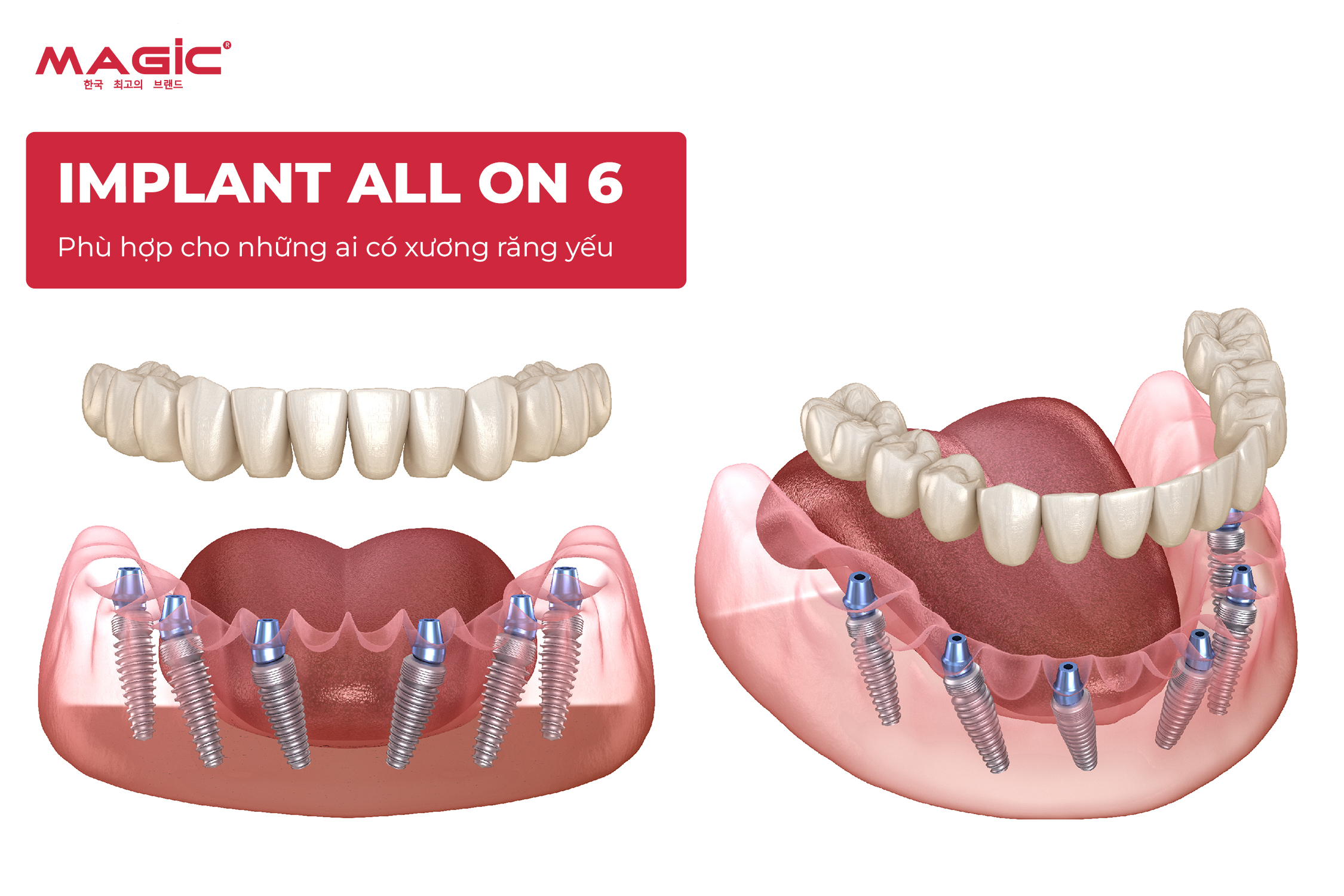 So Sánh Cấy Ghép Implant Toàn Hàm All-on-4, All-on-6, All-on-8 3 So Sánh Cấy Ghép Implant Toàn Hàm All-on-4, All-on-6, All-on-8 3