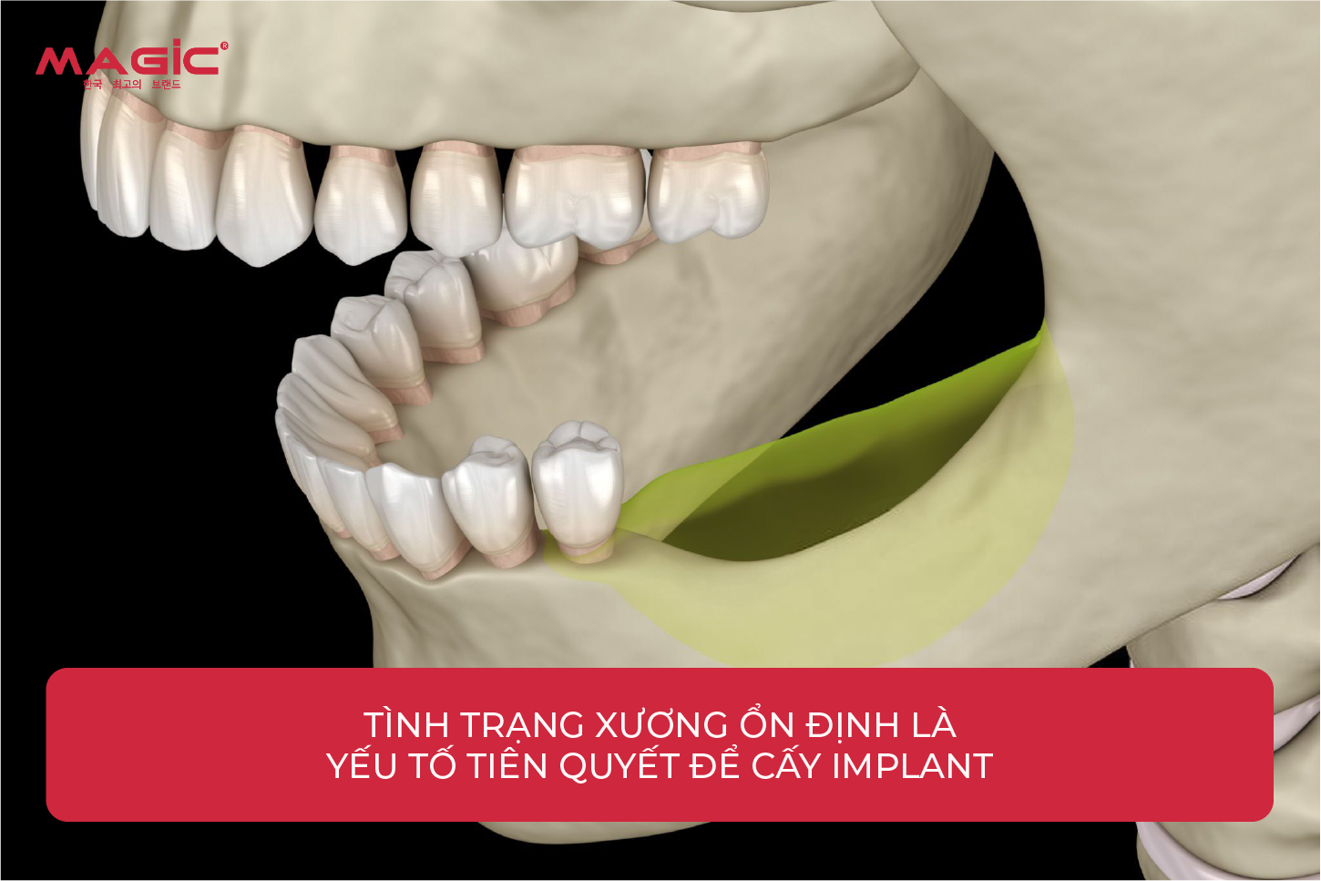 Từ A-Z Cấy Ghép Implant Là Gì? Nên Nắm Rõ Trước Khi Làm 4