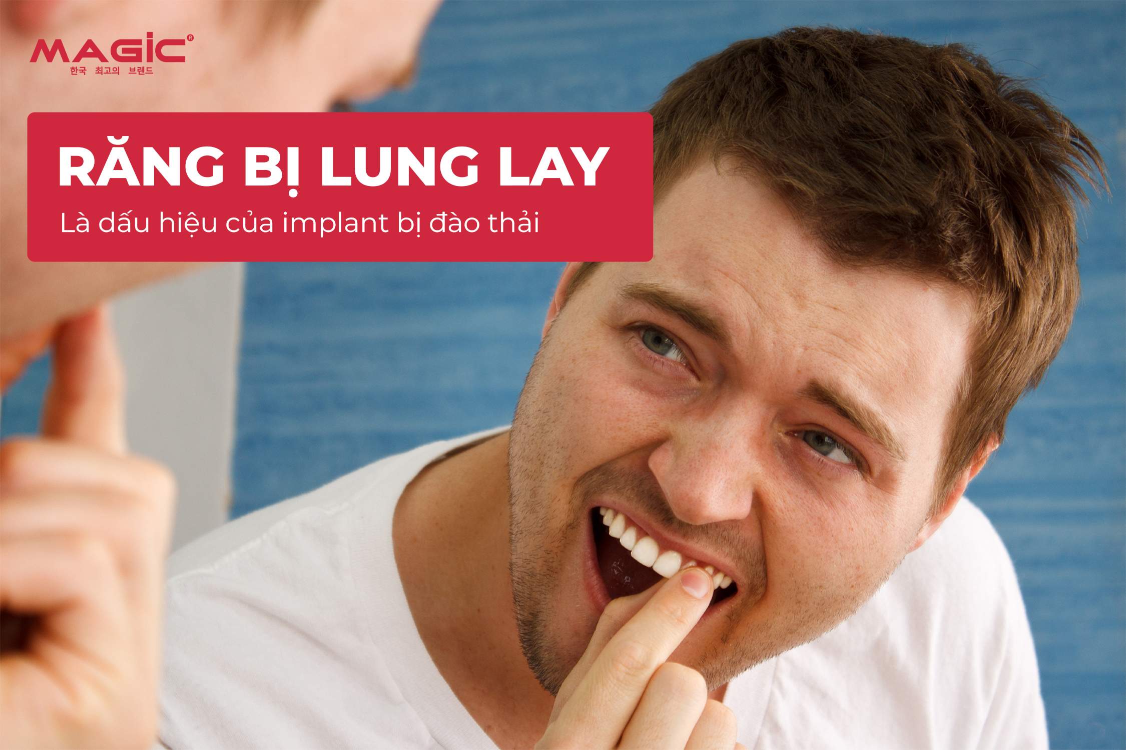 9 Dấu Hiệu Trụ Implant Bị Đào Thải Sau Khi Cấy Implant 4
