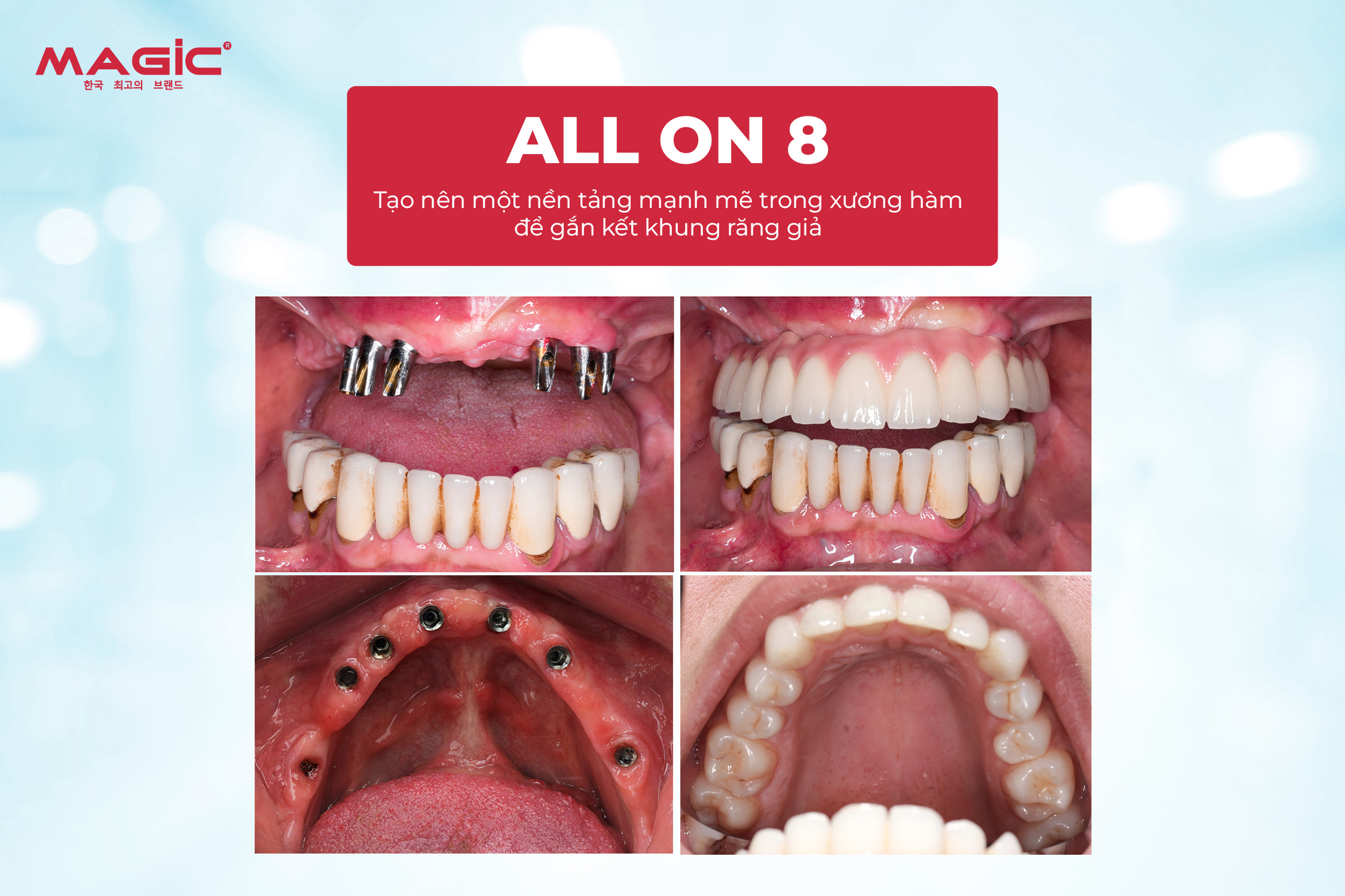 So Sánh Cấy Ghép Implant Toàn Hàm All-on-4, All-on-6, All-on-8 4 So Sánh Cấy Ghép Implant Toàn Hàm All-on-4, All-on-6, All-on-8 4