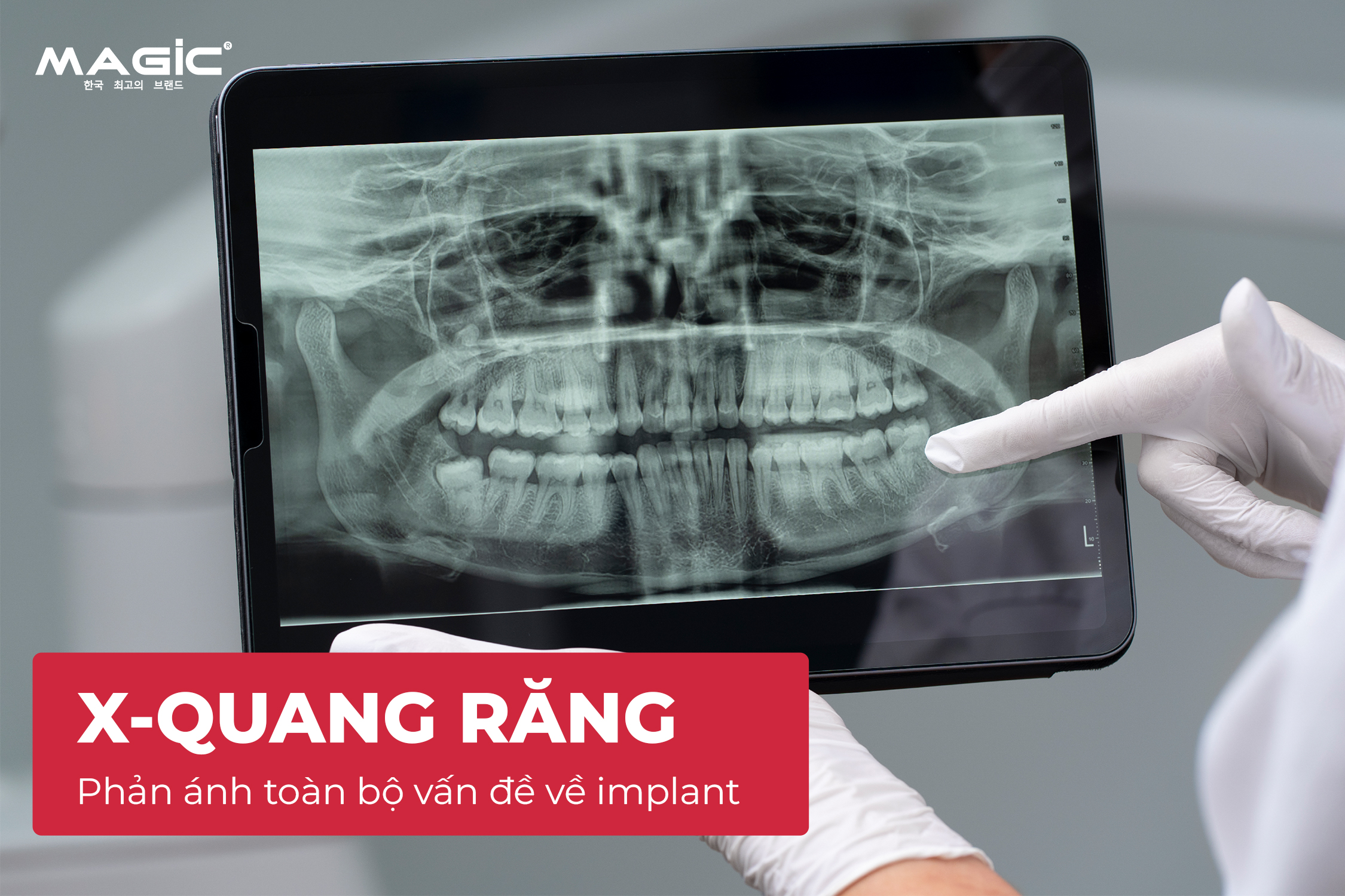 9 Dấu Hiệu Trụ Implant Bị Đào Thải Sau Khi Cấy Implant 5