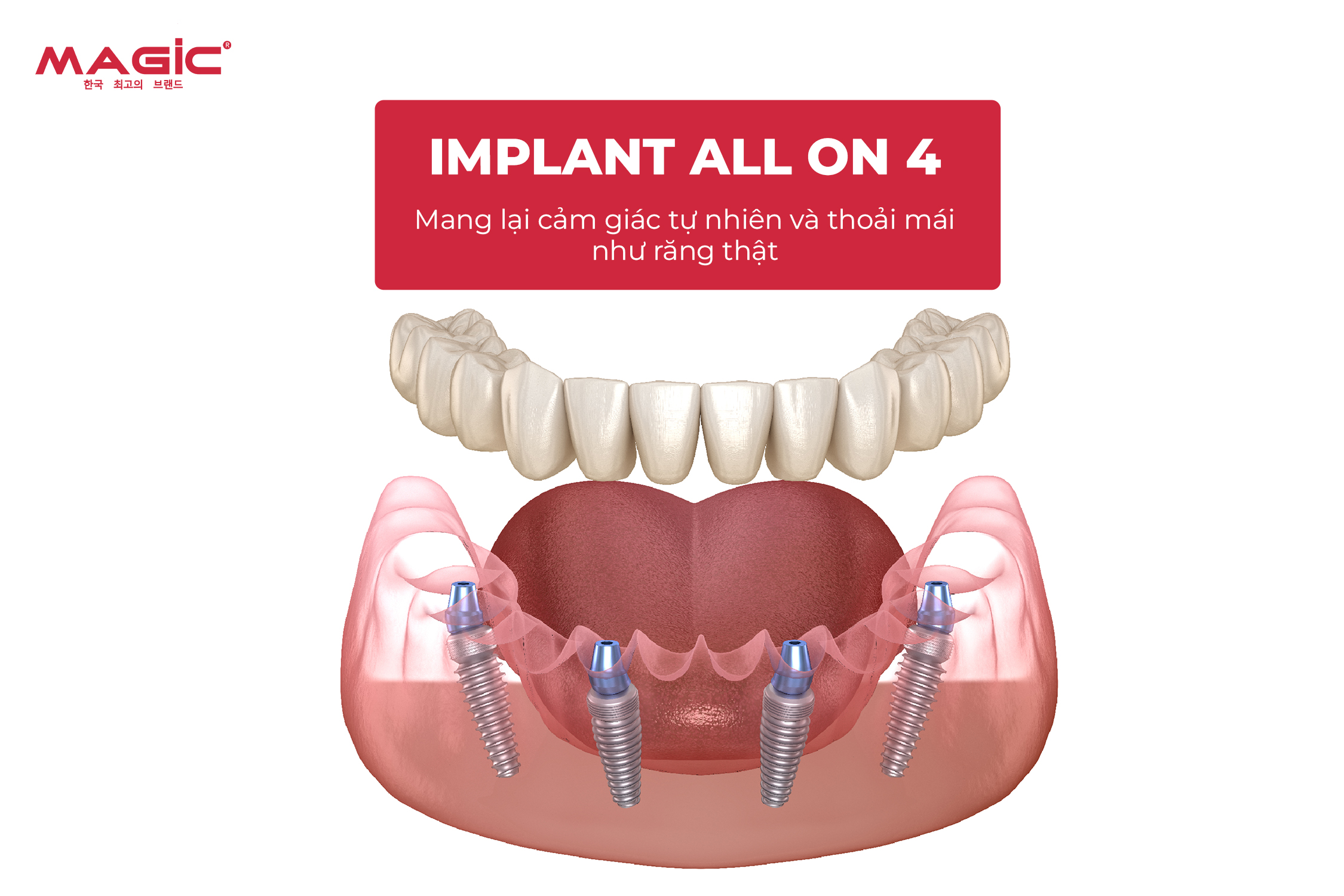 So Sánh Cấy Ghép Implant Toàn Hàm All-on-4, All-on-6, All-on-8 2 So Sánh Cấy Ghép Implant Toàn Hàm All-on-4, All-on-6, All-on-8 2