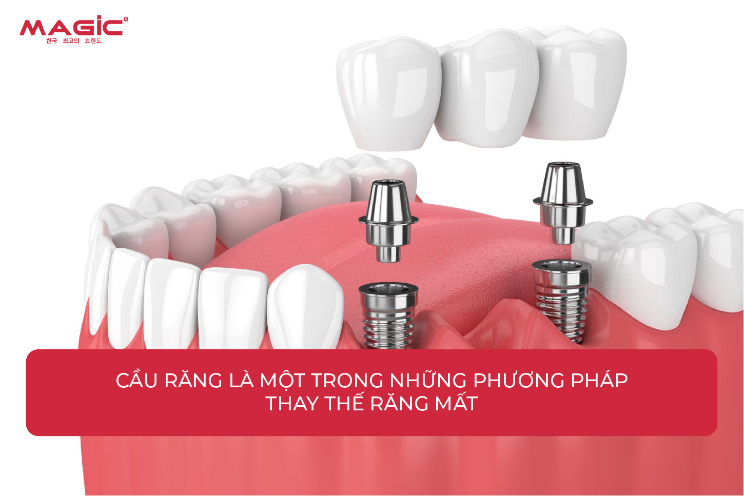 Từ A-Z Cấy Ghép Implant Là Gì? Nên Nắm Rõ Trước Khi Làm 6