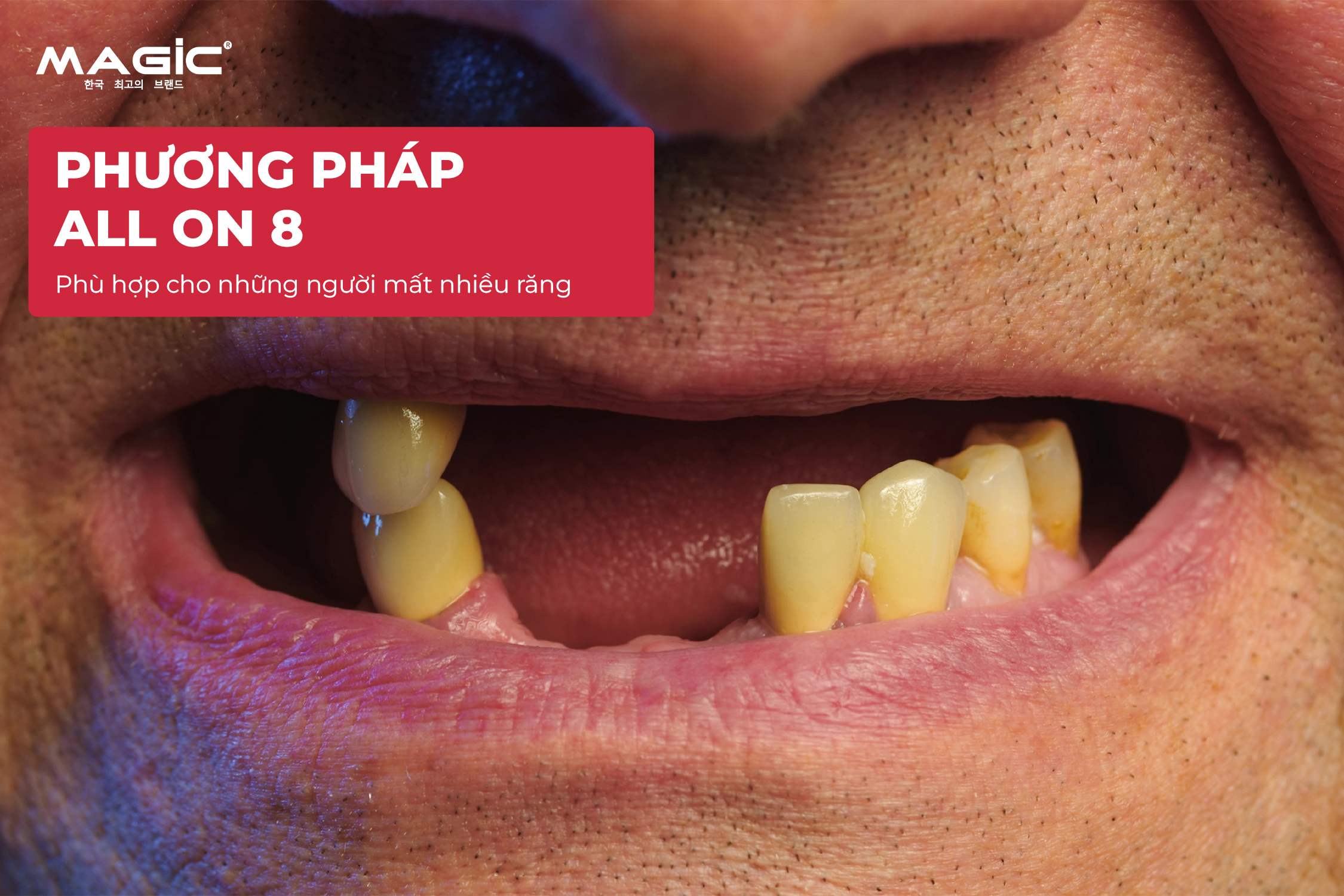 So Sánh Cấy Ghép Implant Toàn Hàm All-on-4, All-on-6, All-on-8 5 So Sánh Cấy Ghép Implant Toàn Hàm All-on-4, All-on-6, All-on-8 5