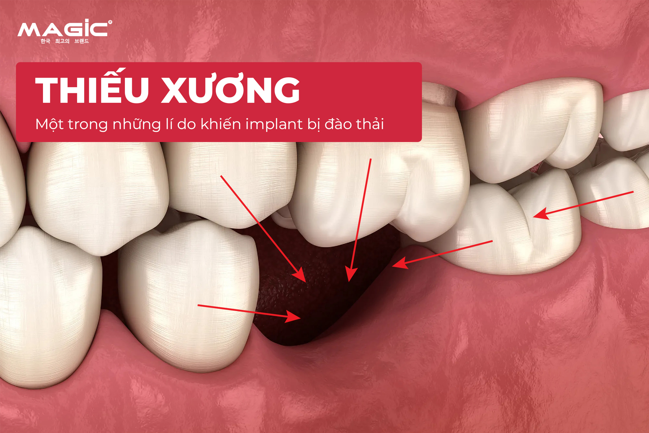 9 Dấu Hiệu Trụ Implant Bị Đào Thải Sau Khi Cấy Implant 6