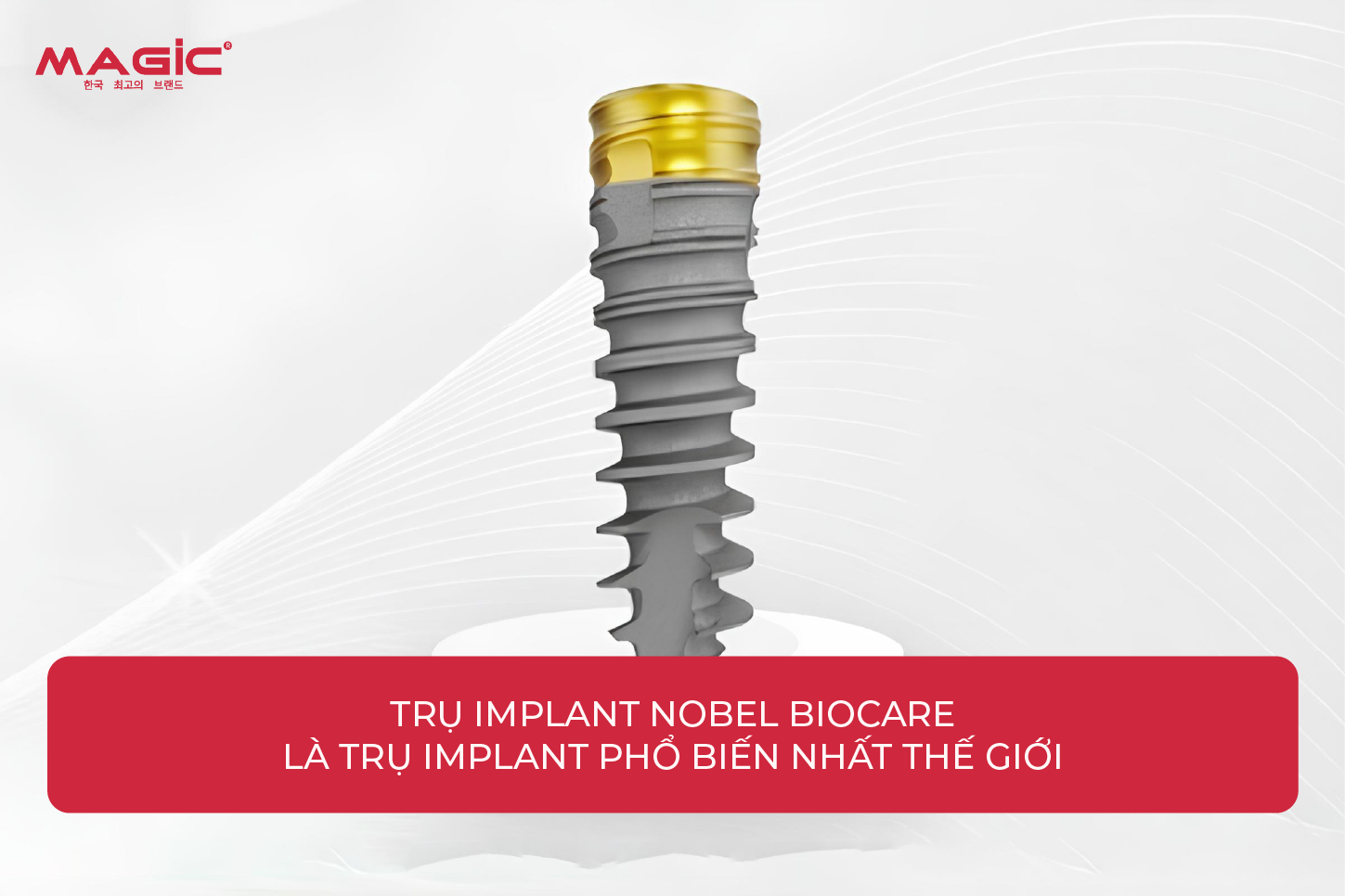 Từ A-Z Cấy Ghép Implant Là Gì? Nên Nắm Rõ Trước Khi Làm 7