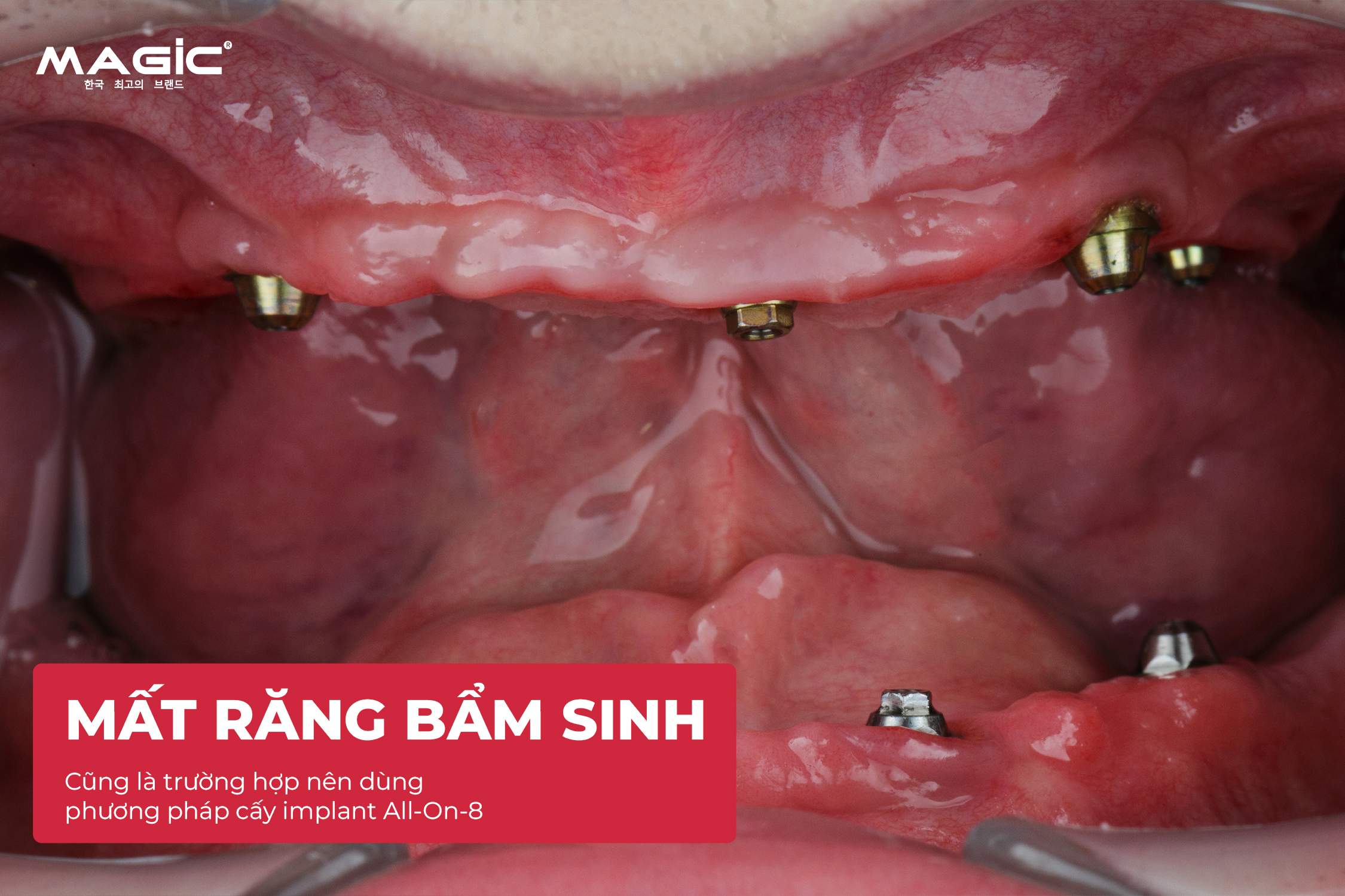 So Sánh Cấy Ghép Implant Toàn Hàm All-on-4, All-on-6, All-on-8 6 So Sánh Cấy Ghép Implant Toàn Hàm All-on-4, All-on-6, All-on-8 6