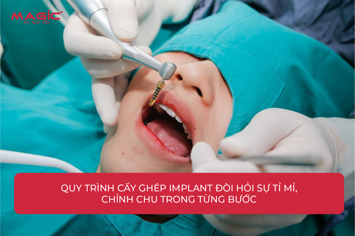 Từ A-Z Cấy Ghép Implant Là Gì? Nên Nắm Rõ Trước Khi Làm 8