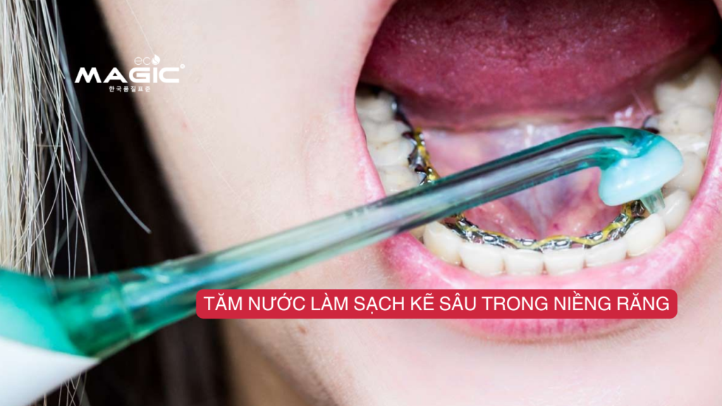 Hướng Dẫn Sử Dụng Tăm Nước Cho Người Niềng Răng 3 Hướng Dẫn Sử Dụng Tăm Nước Cho Người Niềng Răng 3